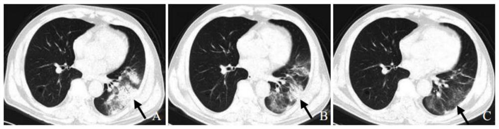 Application of traditional Chinese medicine composition in preparation of medicine for preventing and treating coronavirus complicated with lung injury