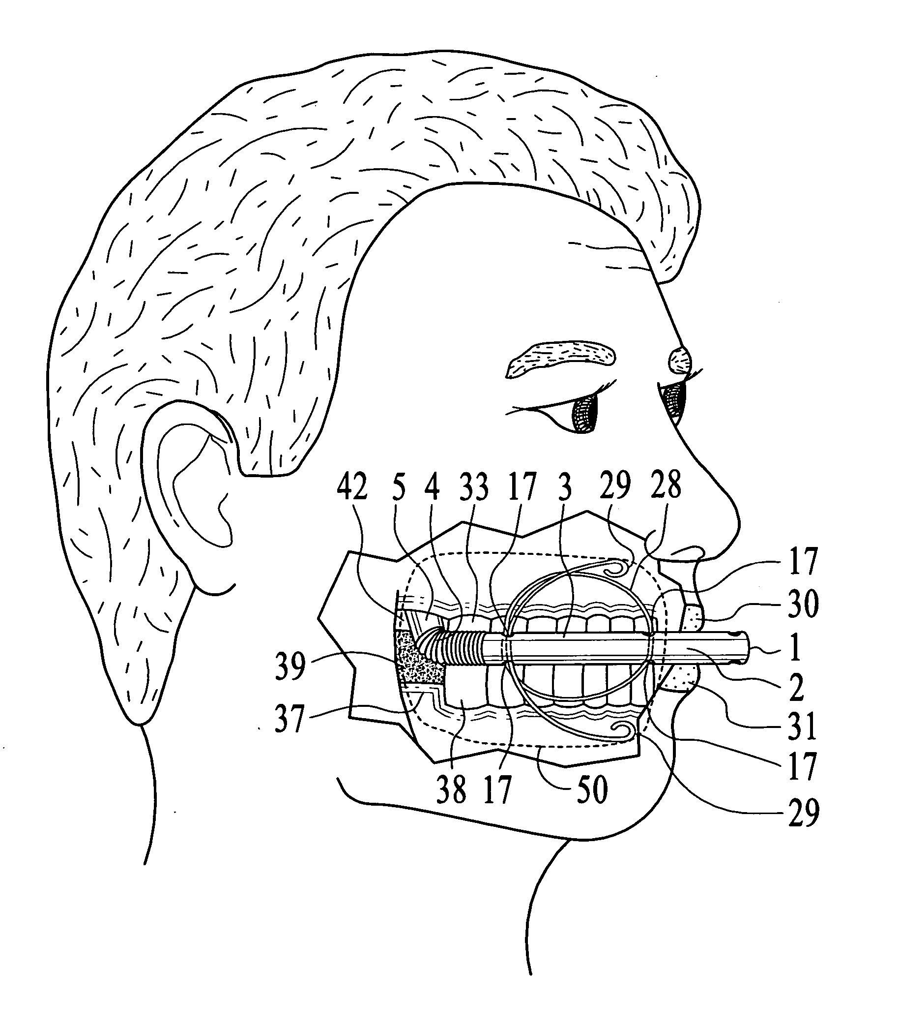 Cheek path airway and cheek pouch anchor