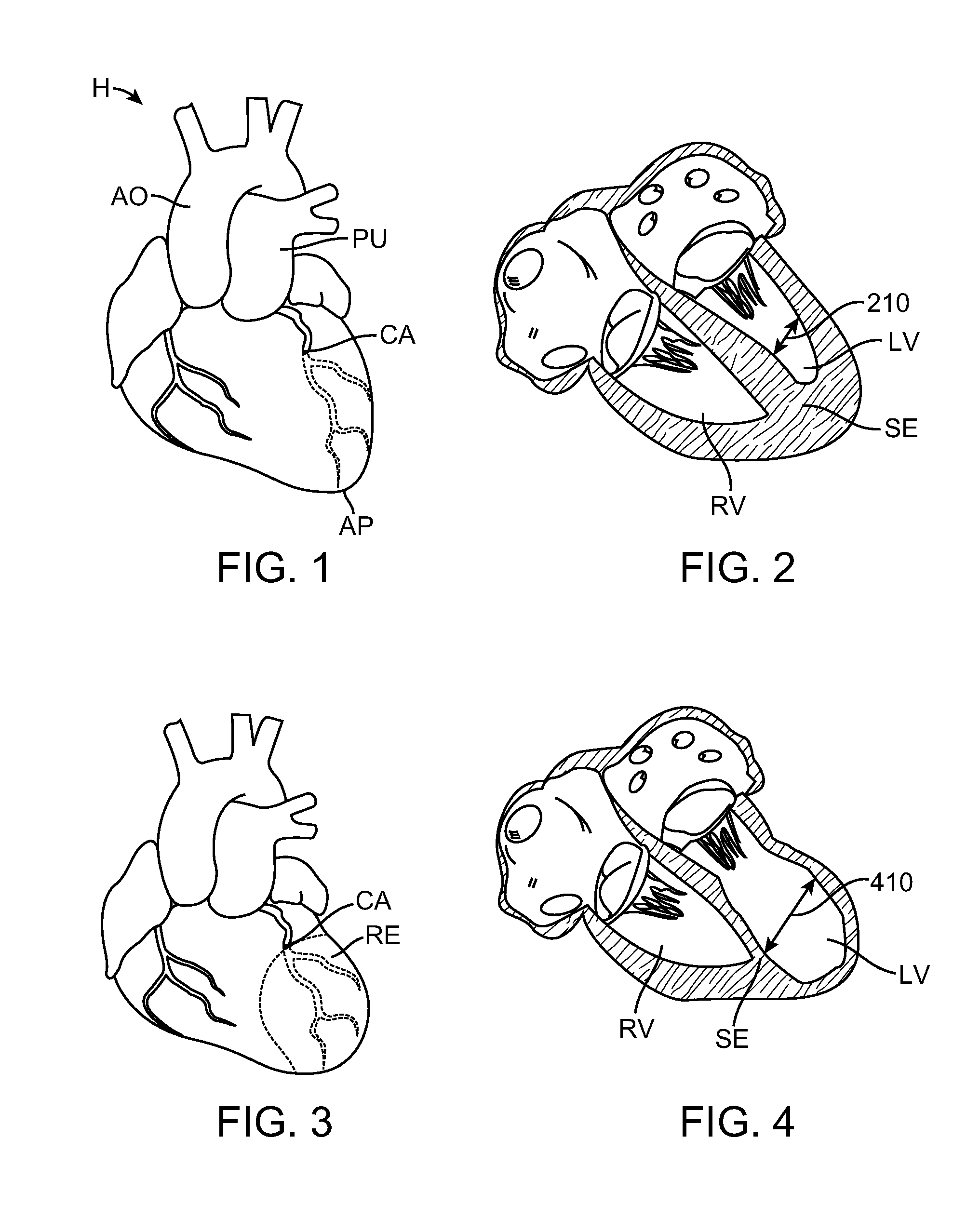 Cardiac Anchor Structures, Methods, and Systems for Treatment of Congestive Heart Failure and Other Conditions