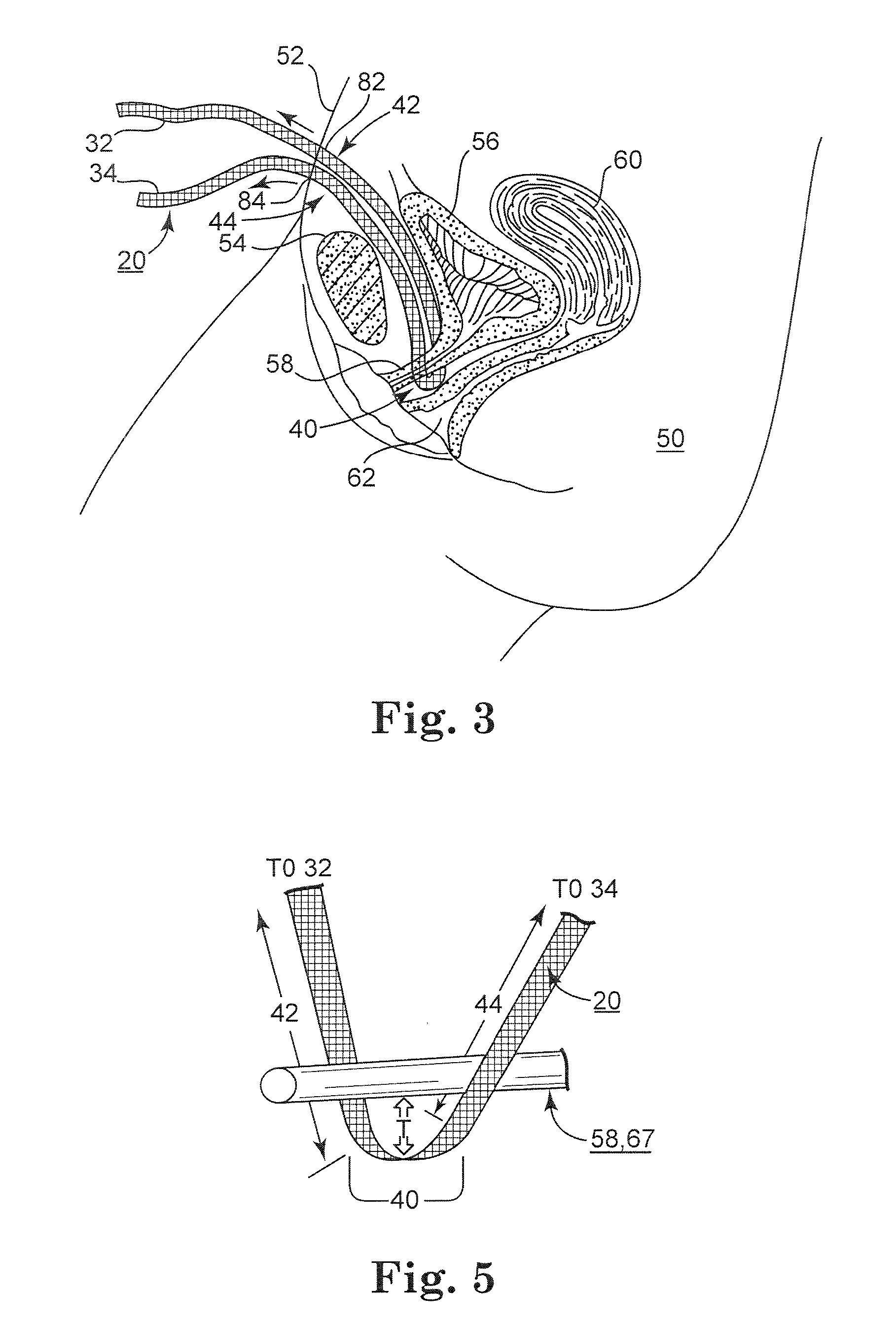 Adjustable Tension Incontinence Sling Assemblies