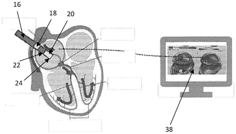 Intracardiac catheter apparatus and methods of use thereof