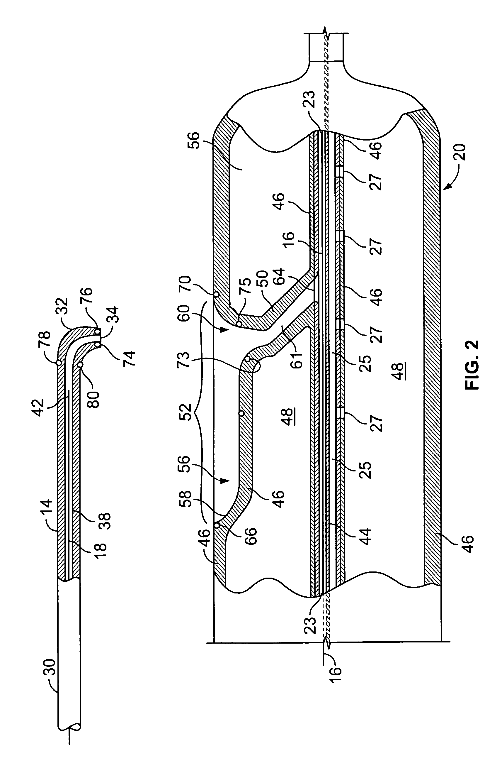 System for treating chronic total occlusion caused by lower extremity arterial disease