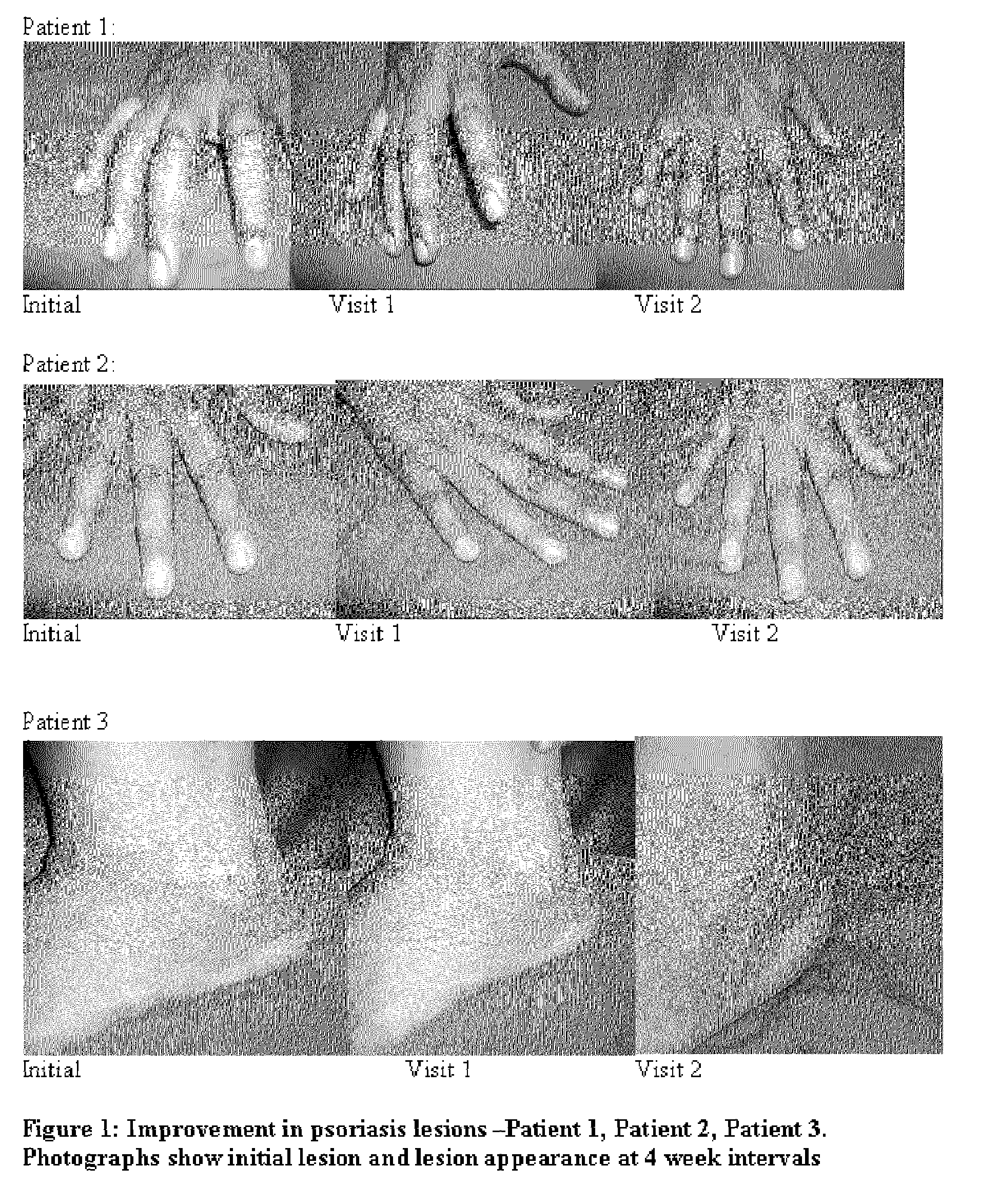 Compositions and methods for the management of hyperproliferative dermatological conditions