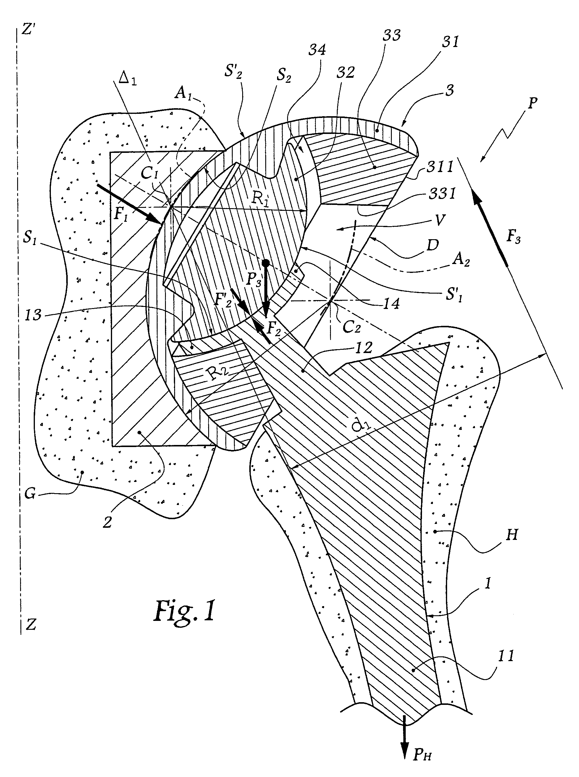 Shoulder or hip prosthesis facilitating abduction