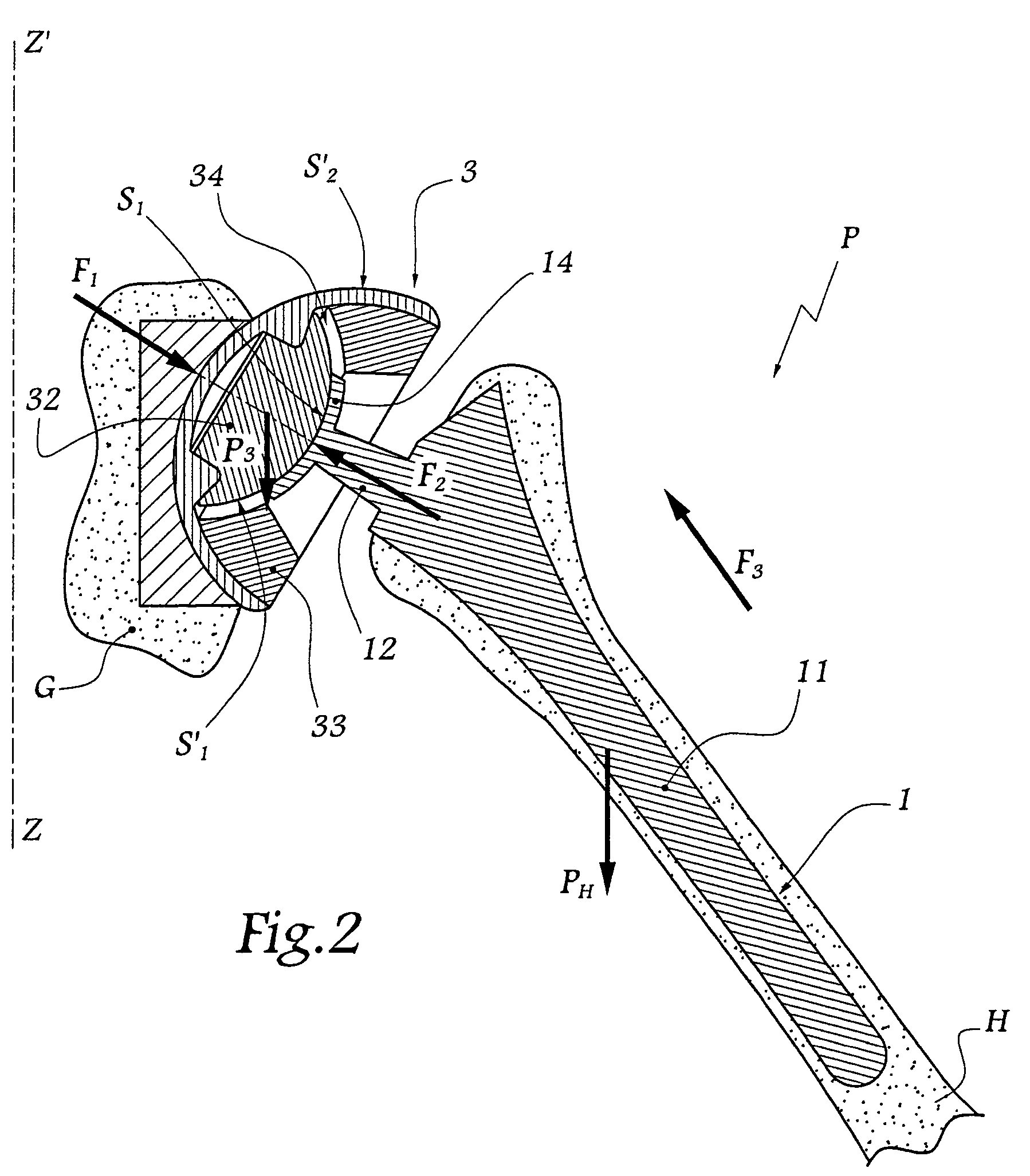 Shoulder or hip prosthesis facilitating abduction