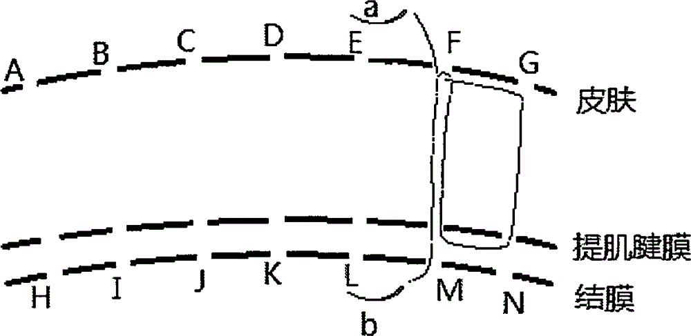 Lock type stitch continuous suture method double-lid blepharoplasty