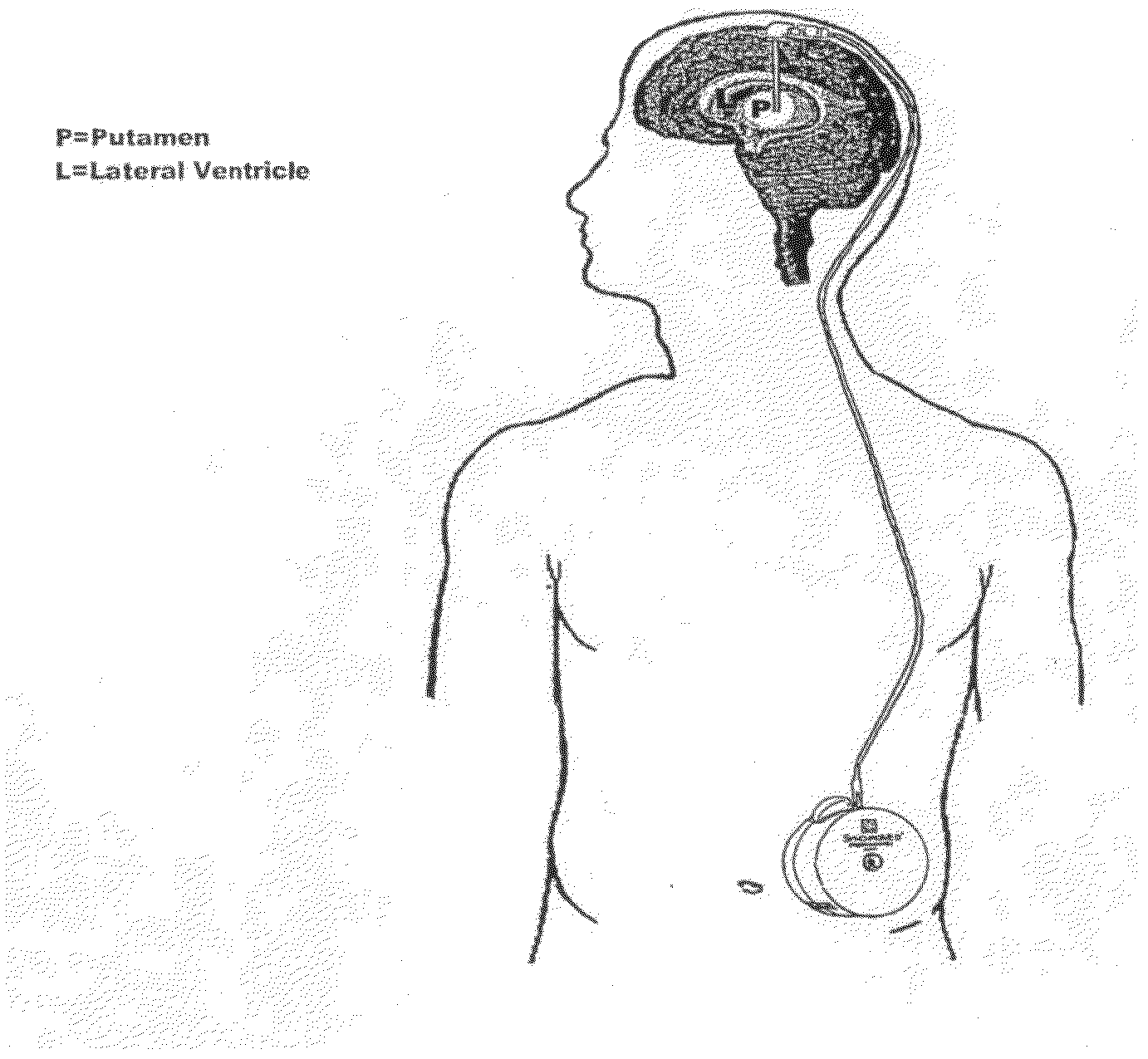 Method of Treating Parkinson's Disease in Humans by Convection-Enhanced Infusion of Glial Cell-Line Derived Neurotrophic Factor to the Putamen