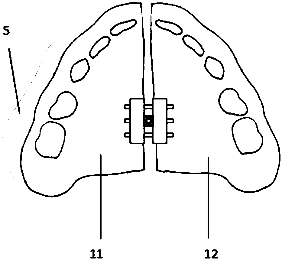 Maxillary expansion type occlusal pad