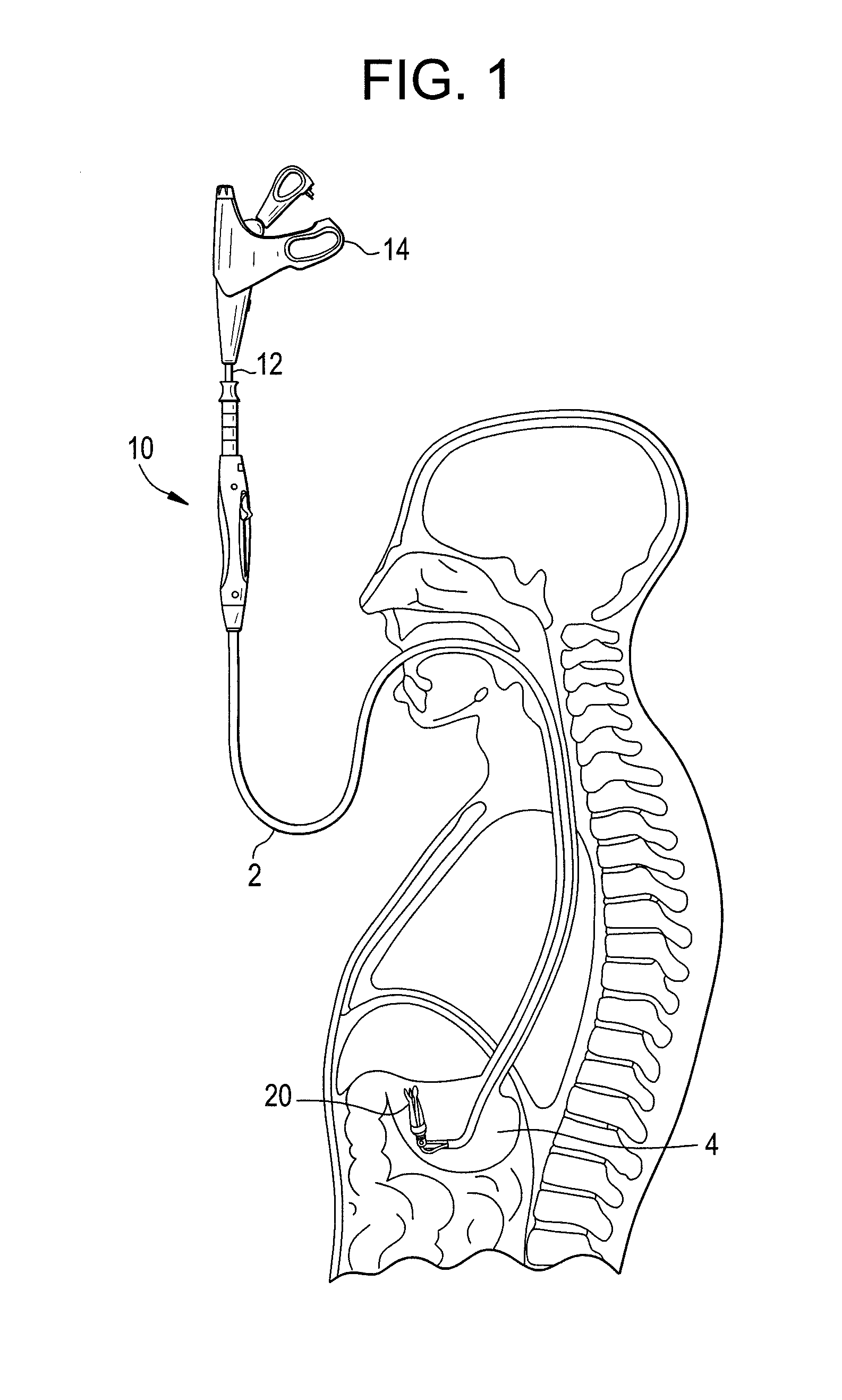 Endoluminal fold creation