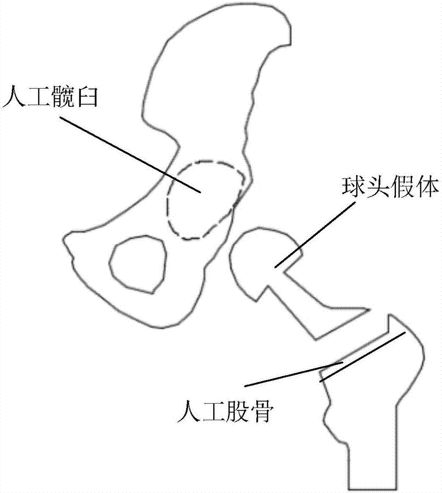 Dislocation detecting system in hip joint replacement