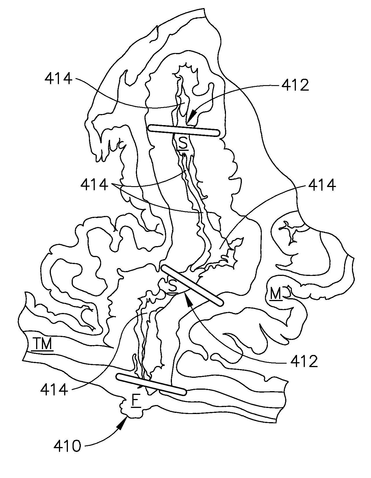 Methods of forming a laparoscopic greater curvature plication using a surgical stapler