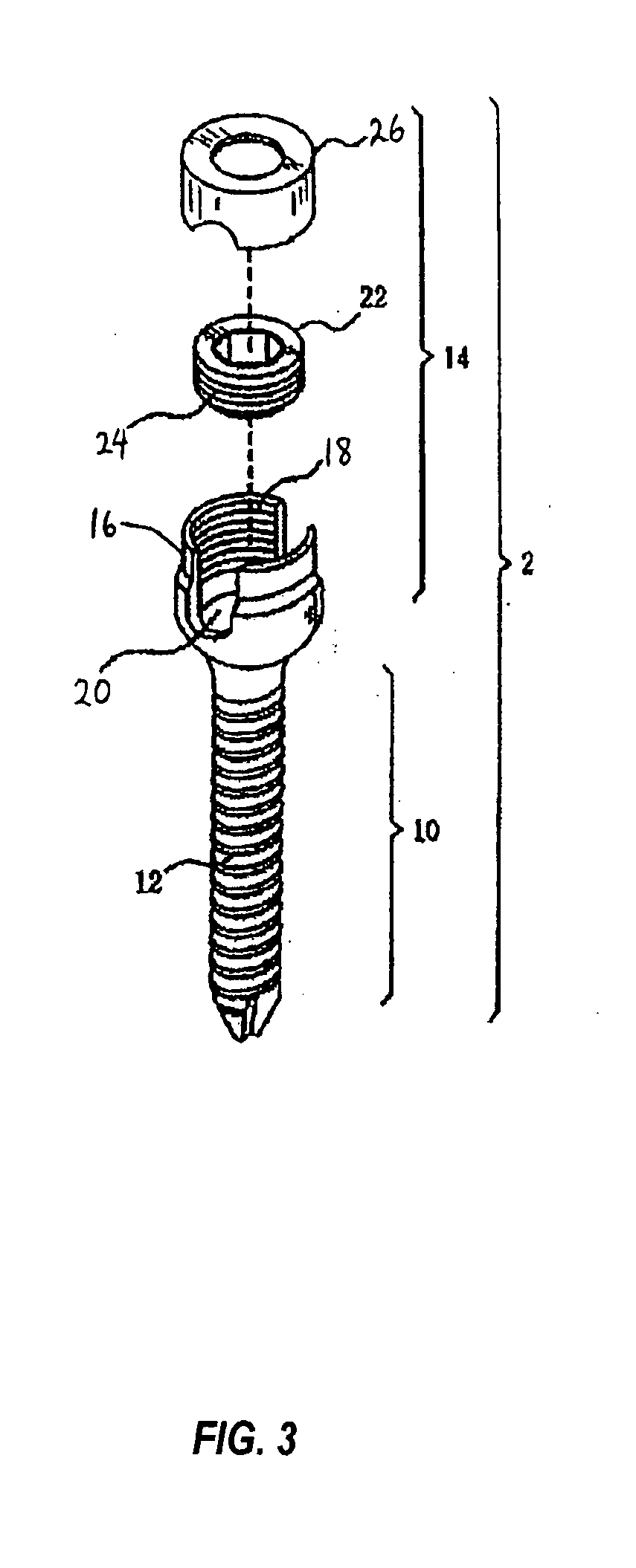 Spinal stabilization device