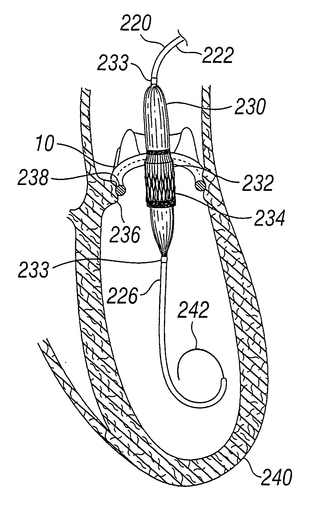 Prosthetic Heart Valve Configured to Receive a Percutaneous Prosthetic Heart Valve Implantation