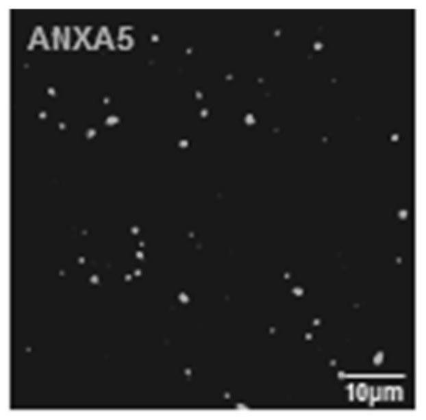 Application of apoptotic body in preparation of medicine for treating acute lung injury