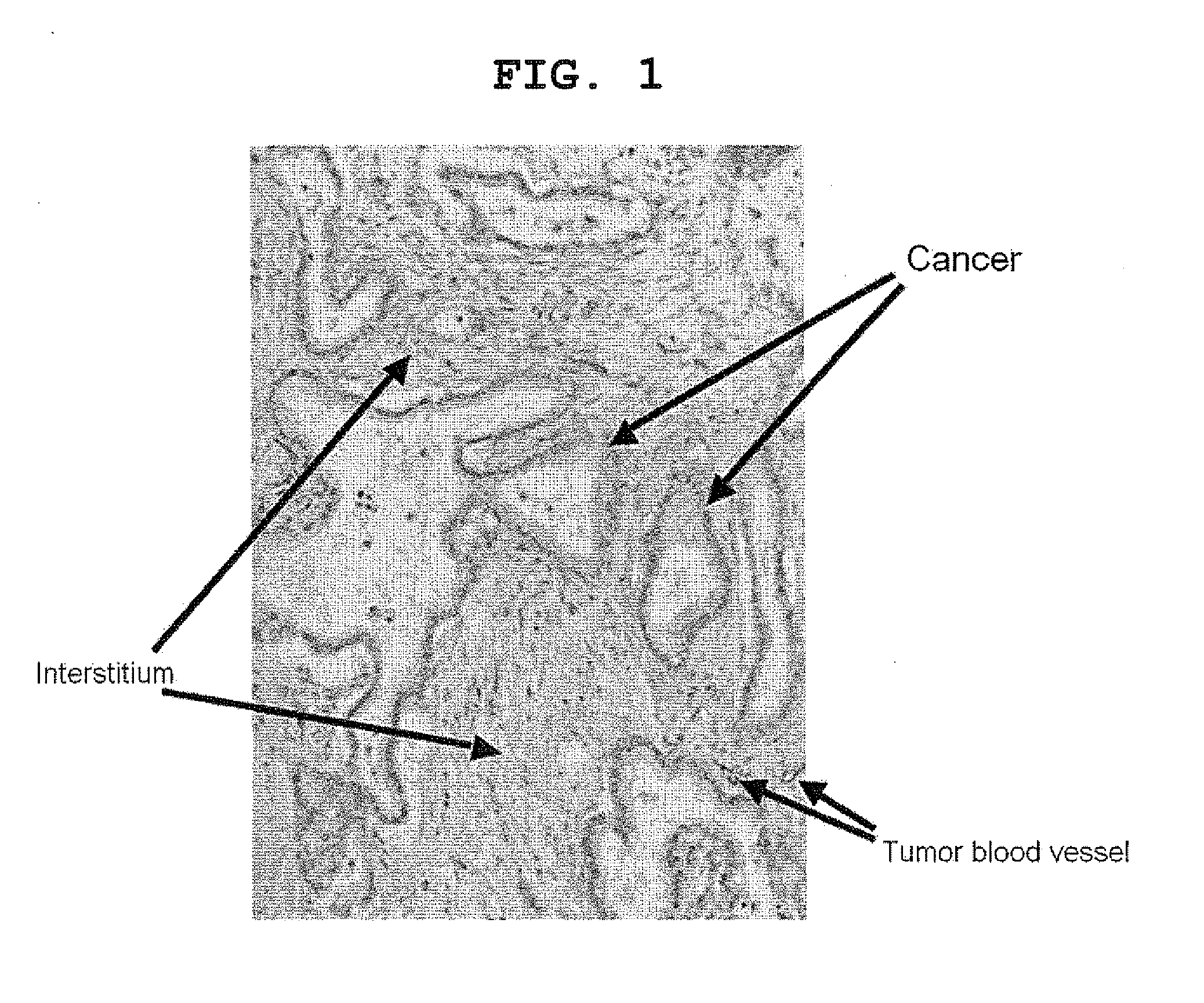 Novel cancer targeting therapy using complex of subtance capable of binding specifically to constituent factor of cancer stroma and Anti-tumor compound