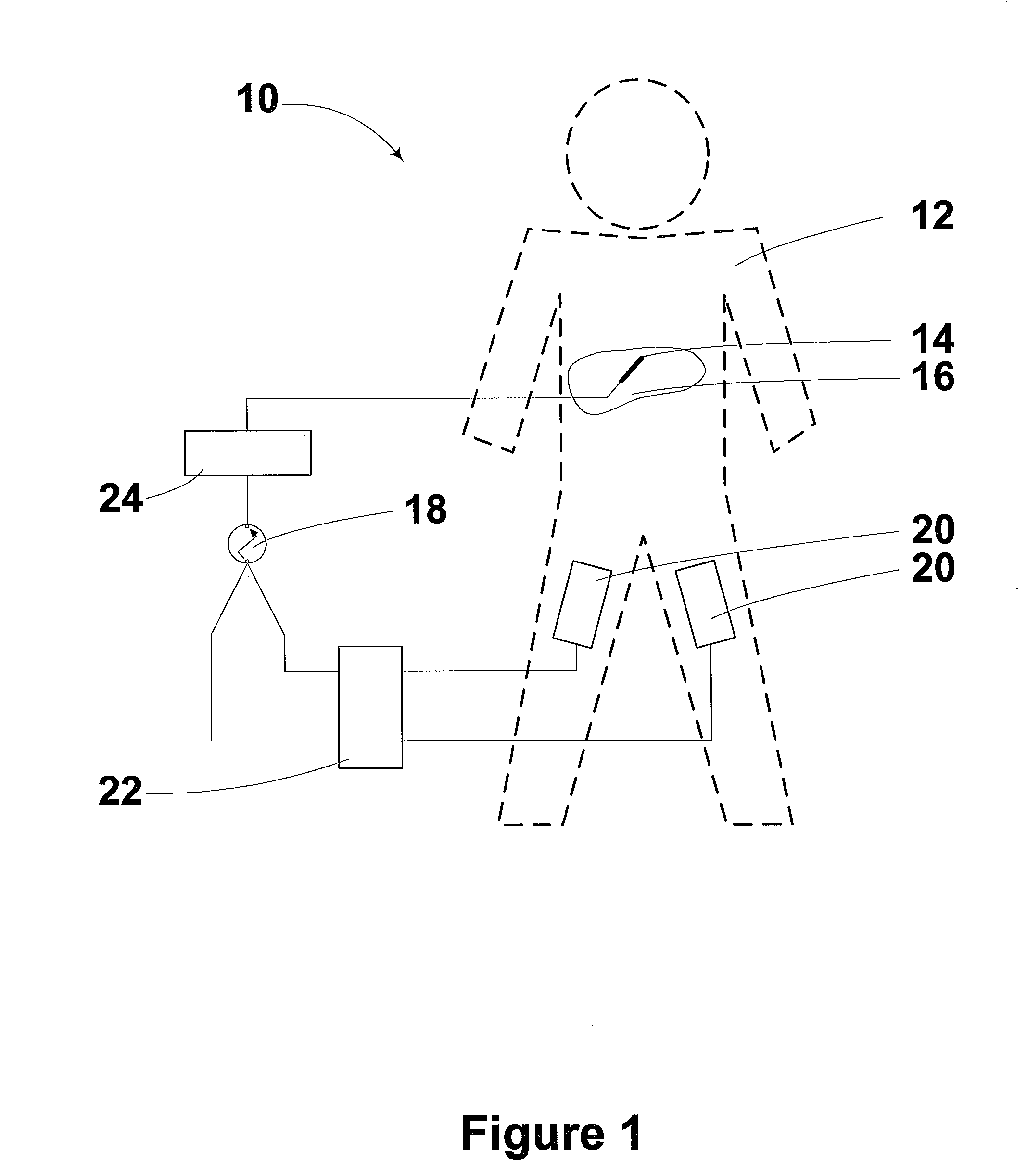 Radiofrequency ablation device for reducing the incidence of skin burns