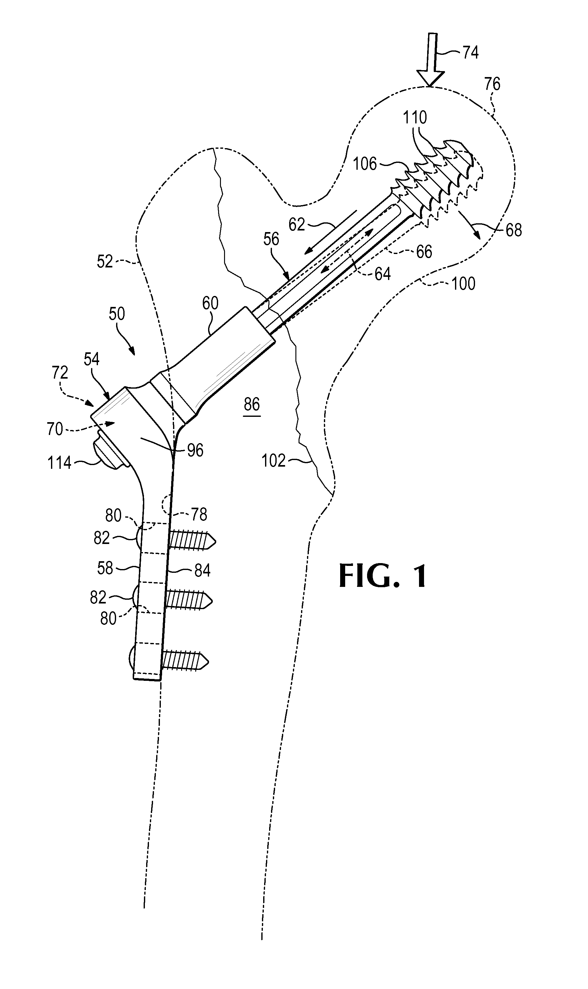 Plate-based compliant hip fixation system