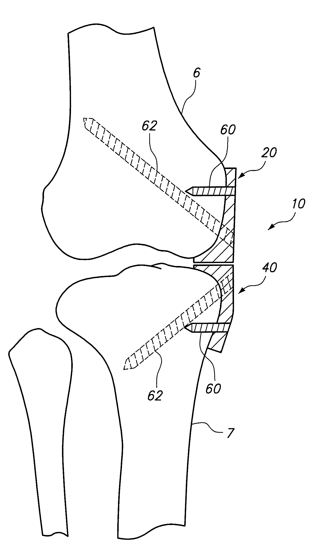 Implantable brace for providing joint support