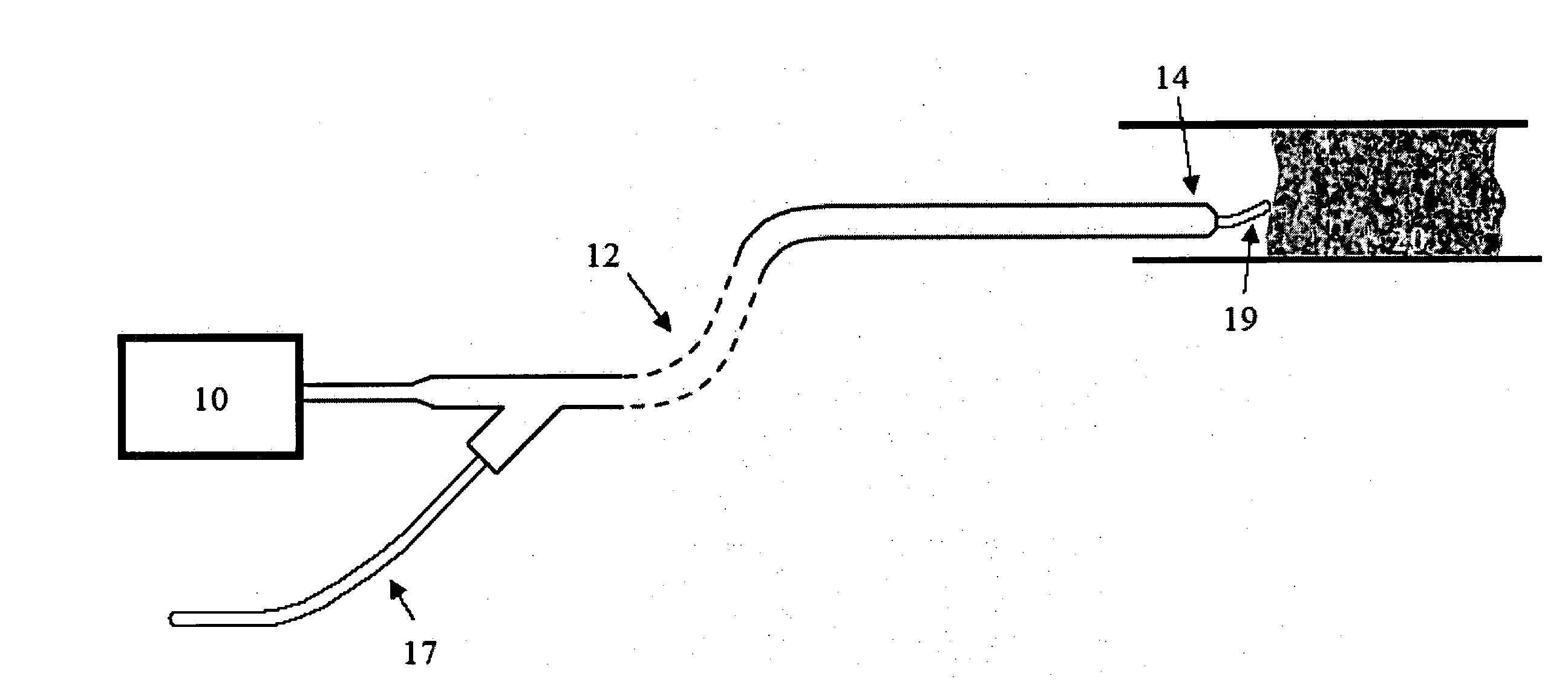 Image-guided laser catheter