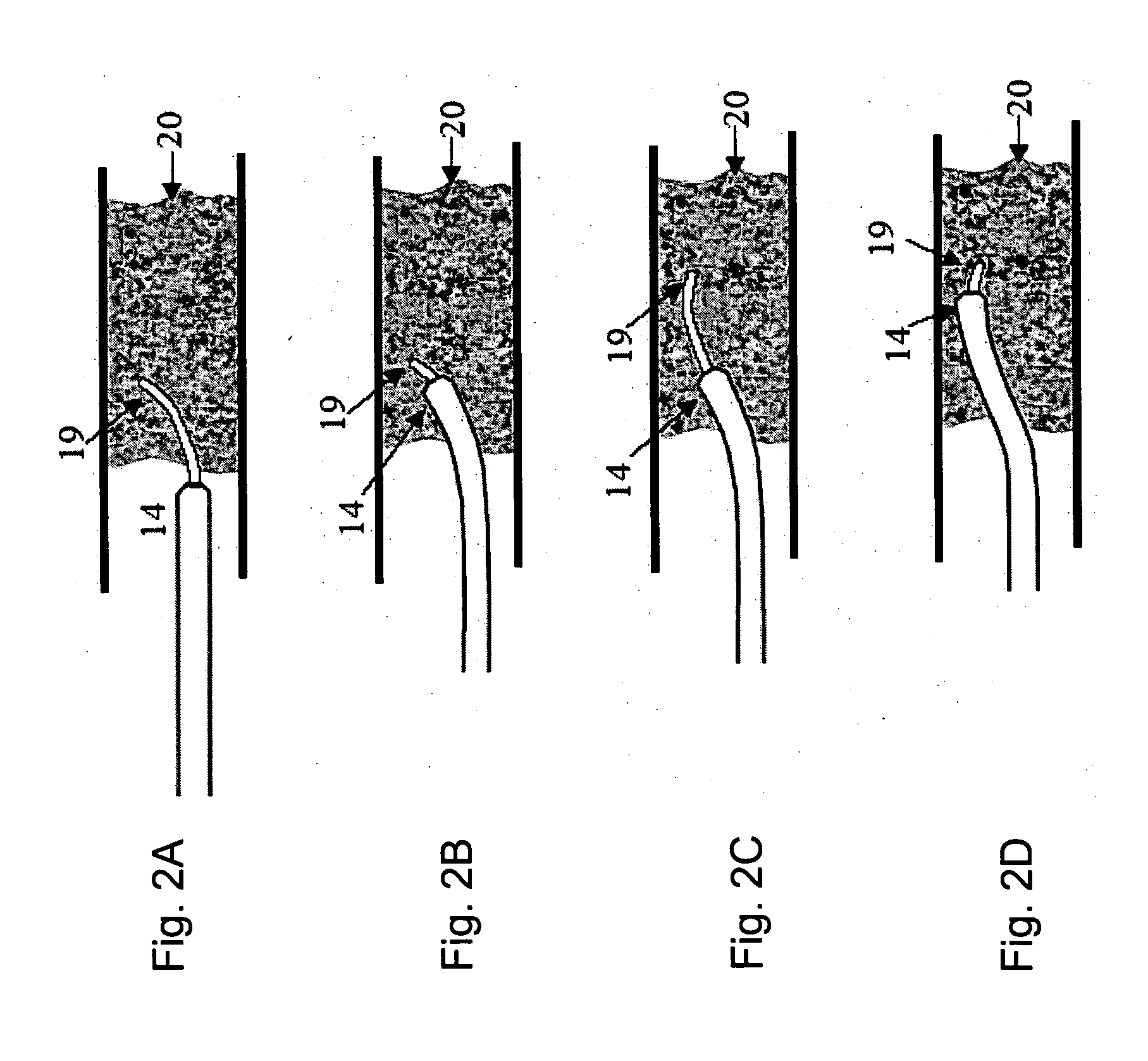 Image-guided laser catheter