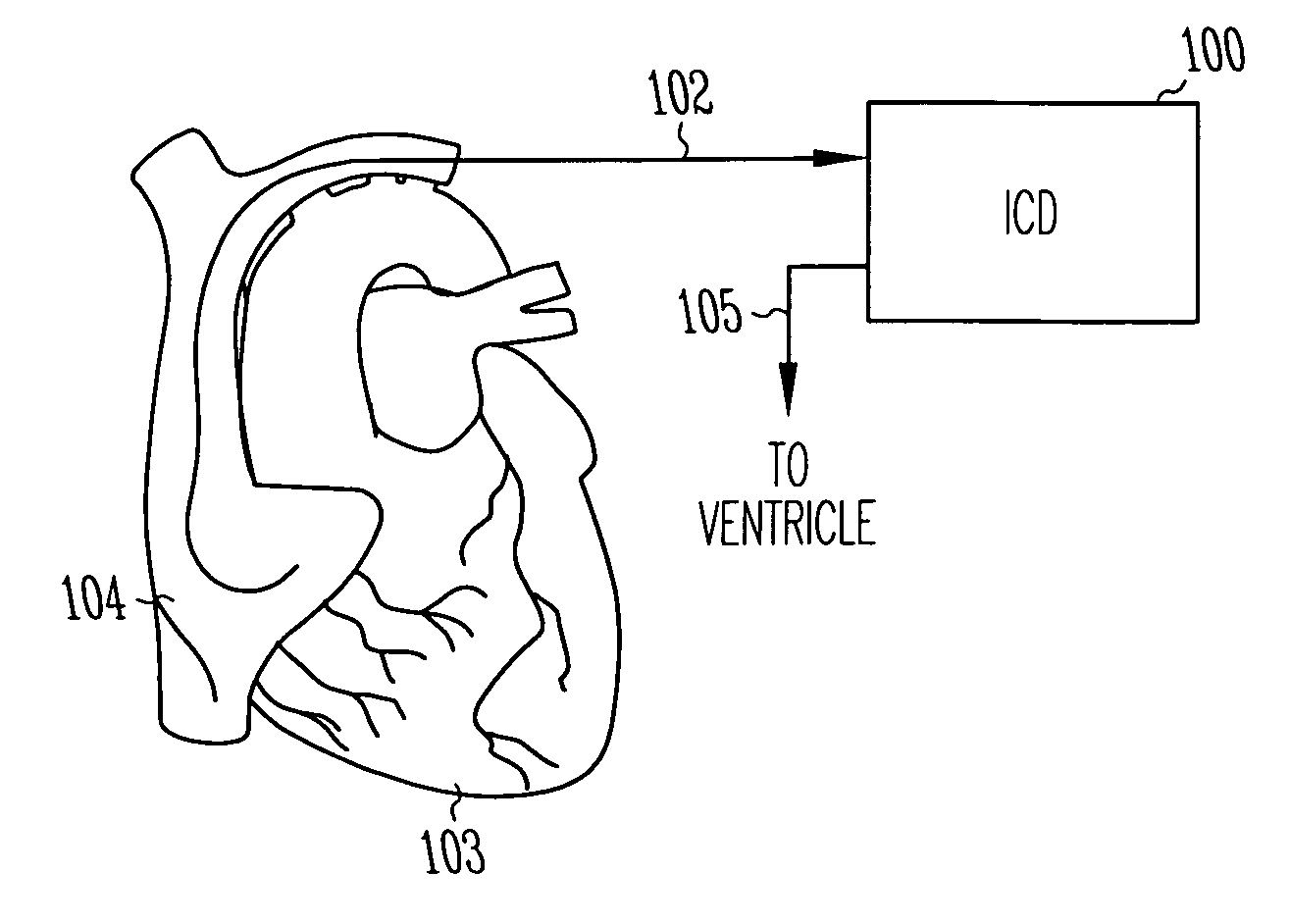 Distinguishing sinus tachycardia from atrial fibrillation and atrial flutter through analysis of atrial channel wavelet transforms