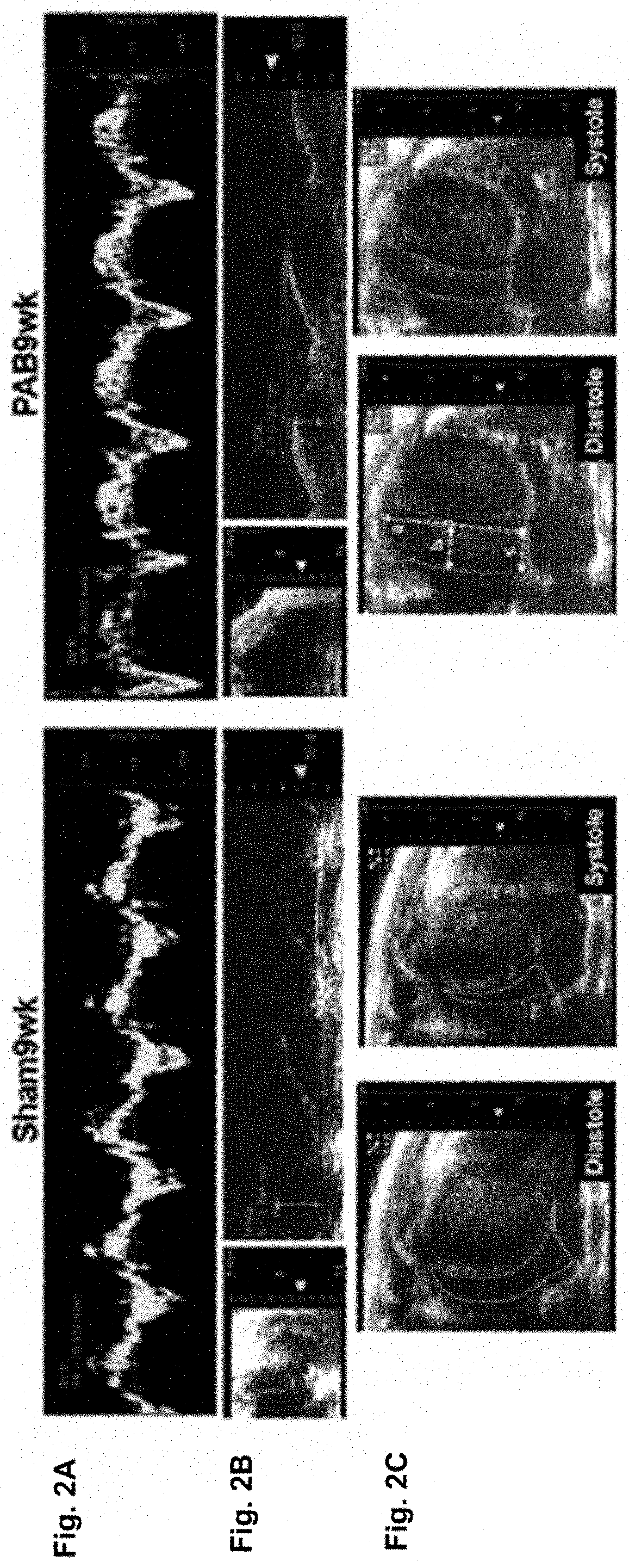 Pharmacologic treatment for right ventricular failure