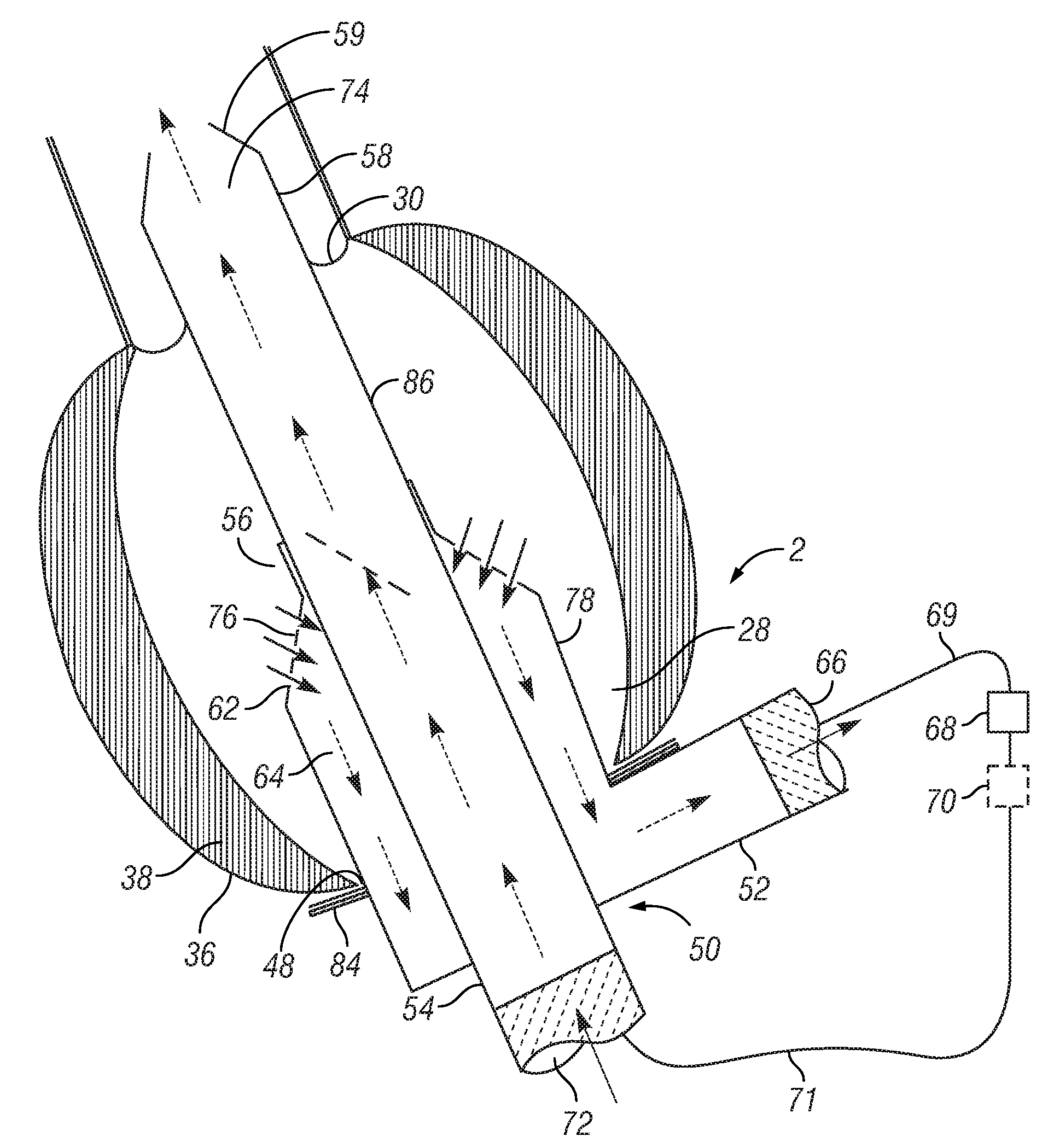 Apex to aorta cannula assembly