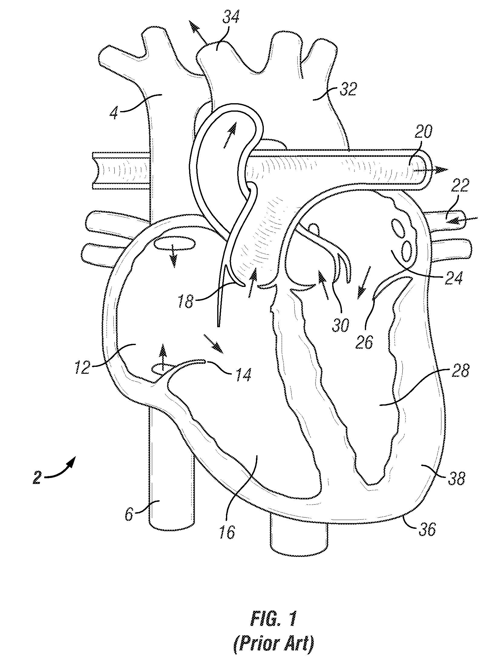 Apex to aorta cannula assembly