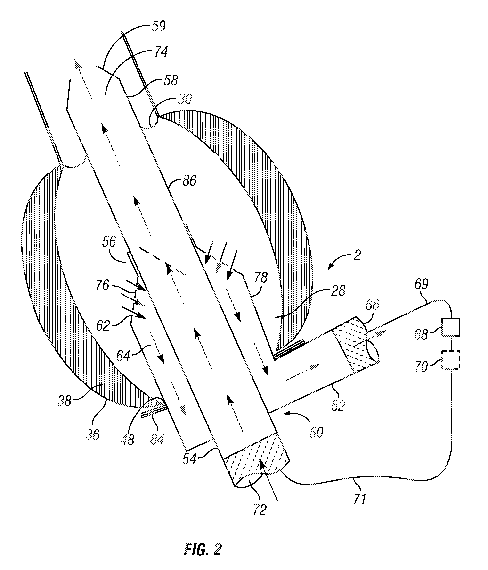 Apex to aorta cannula assembly