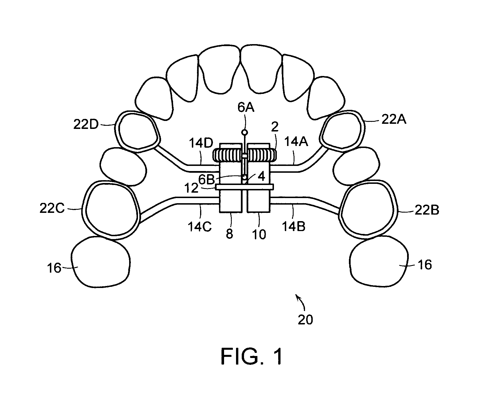 Palatal expansion device and methods