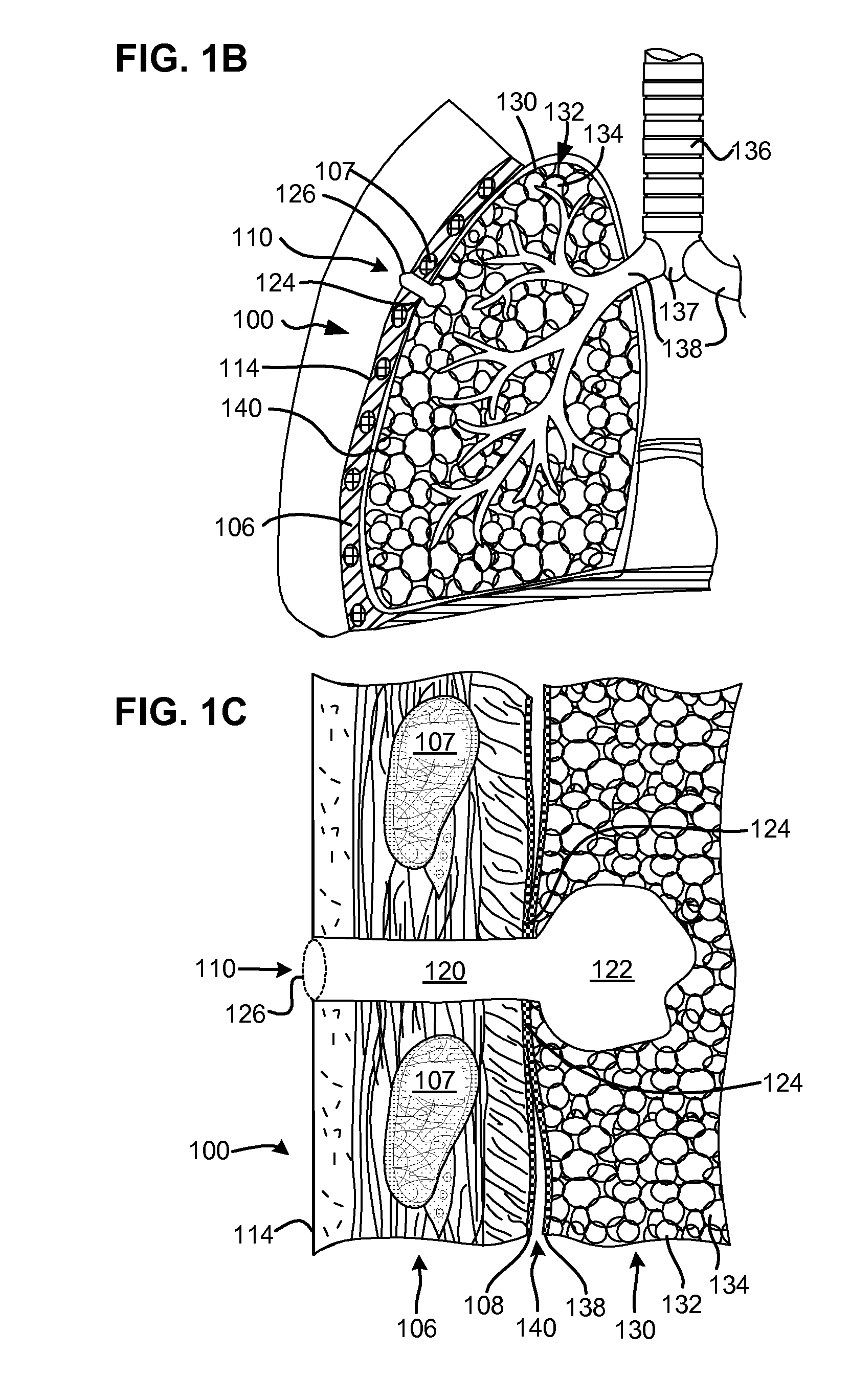 Single-phase surgical procedure for creating a pneumostoma to treat chronic obstructive pulmonary disease