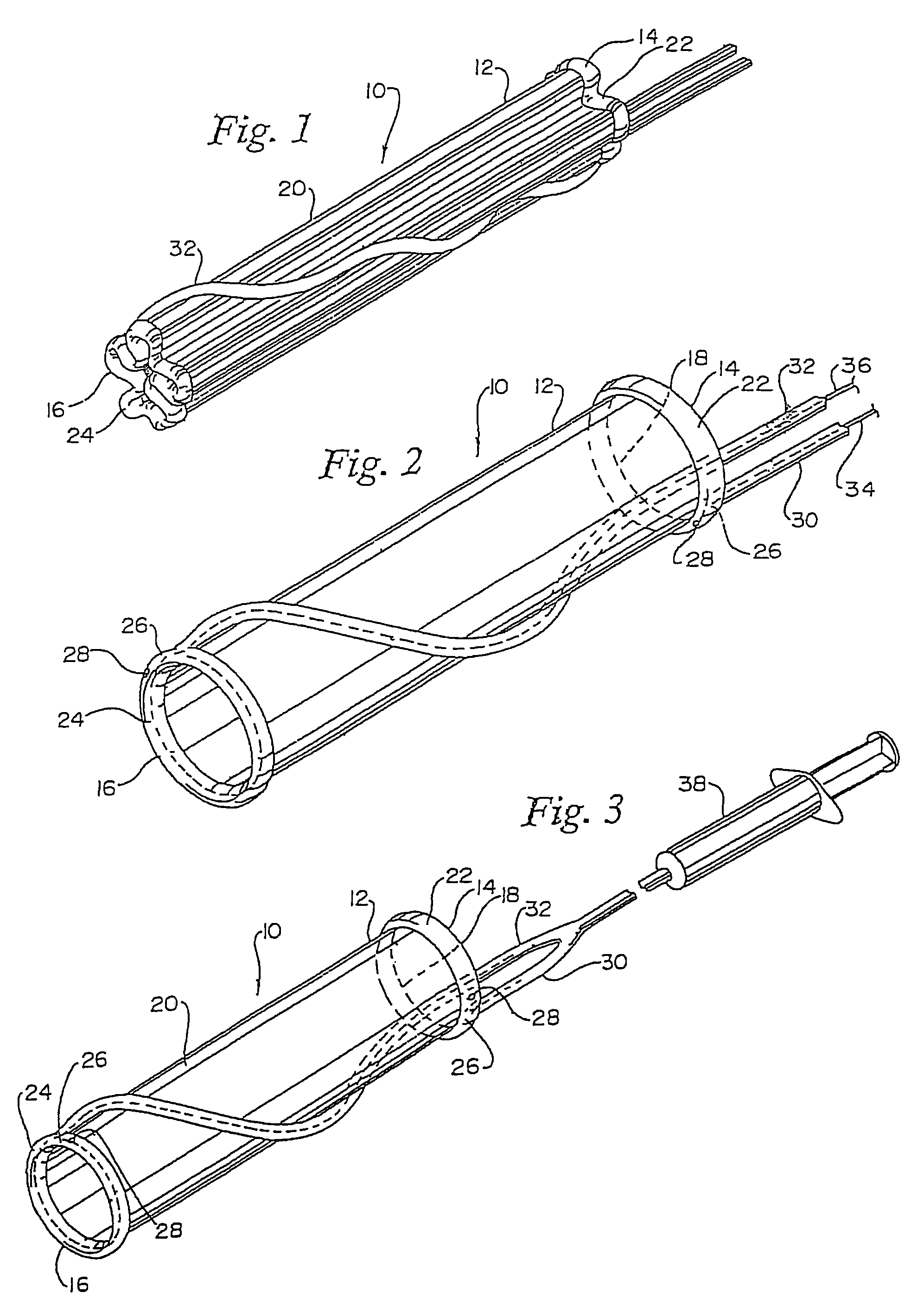 Endovascular apparatus