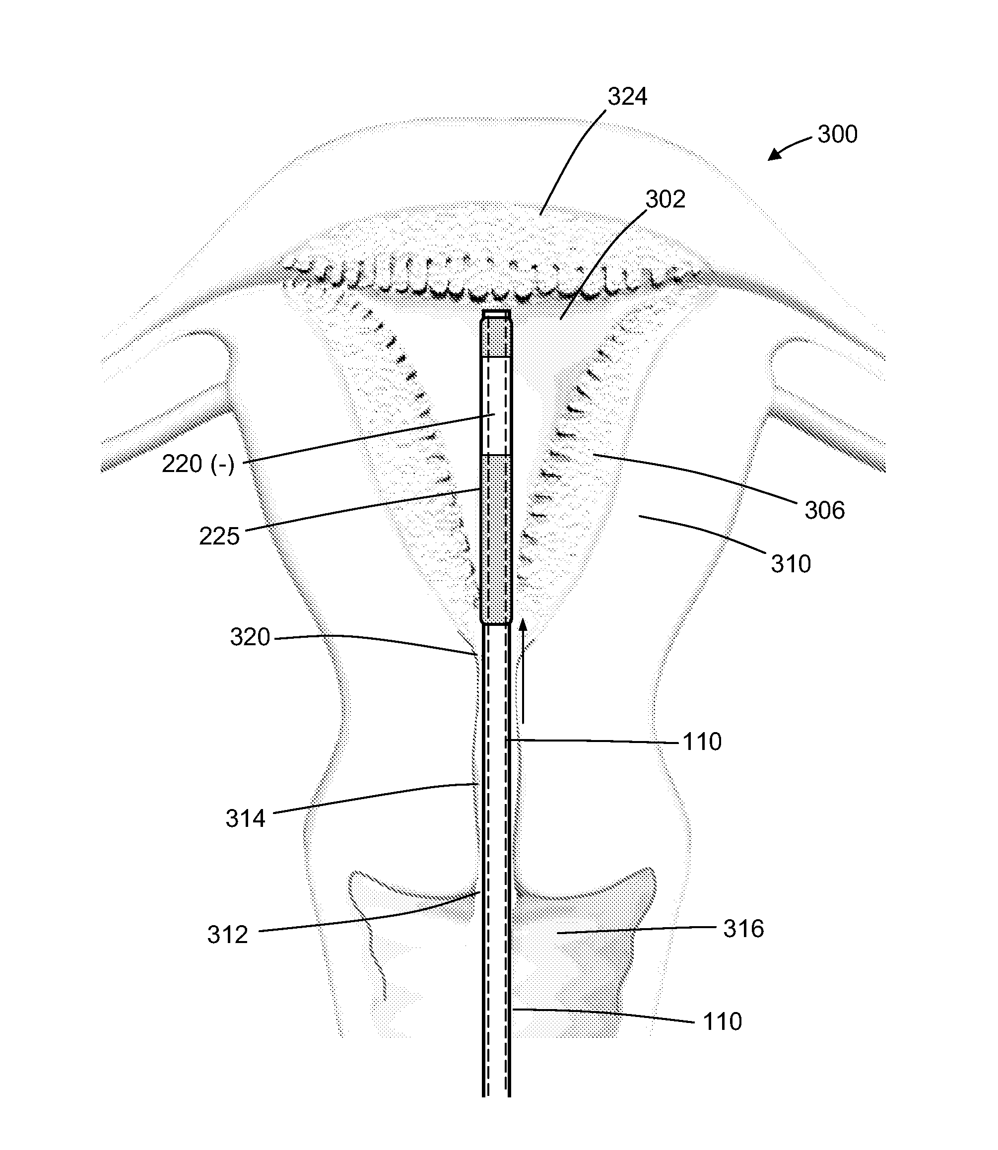 Endometrial ablation with a device that conforms to symmetric or asymmetric uterine cavities