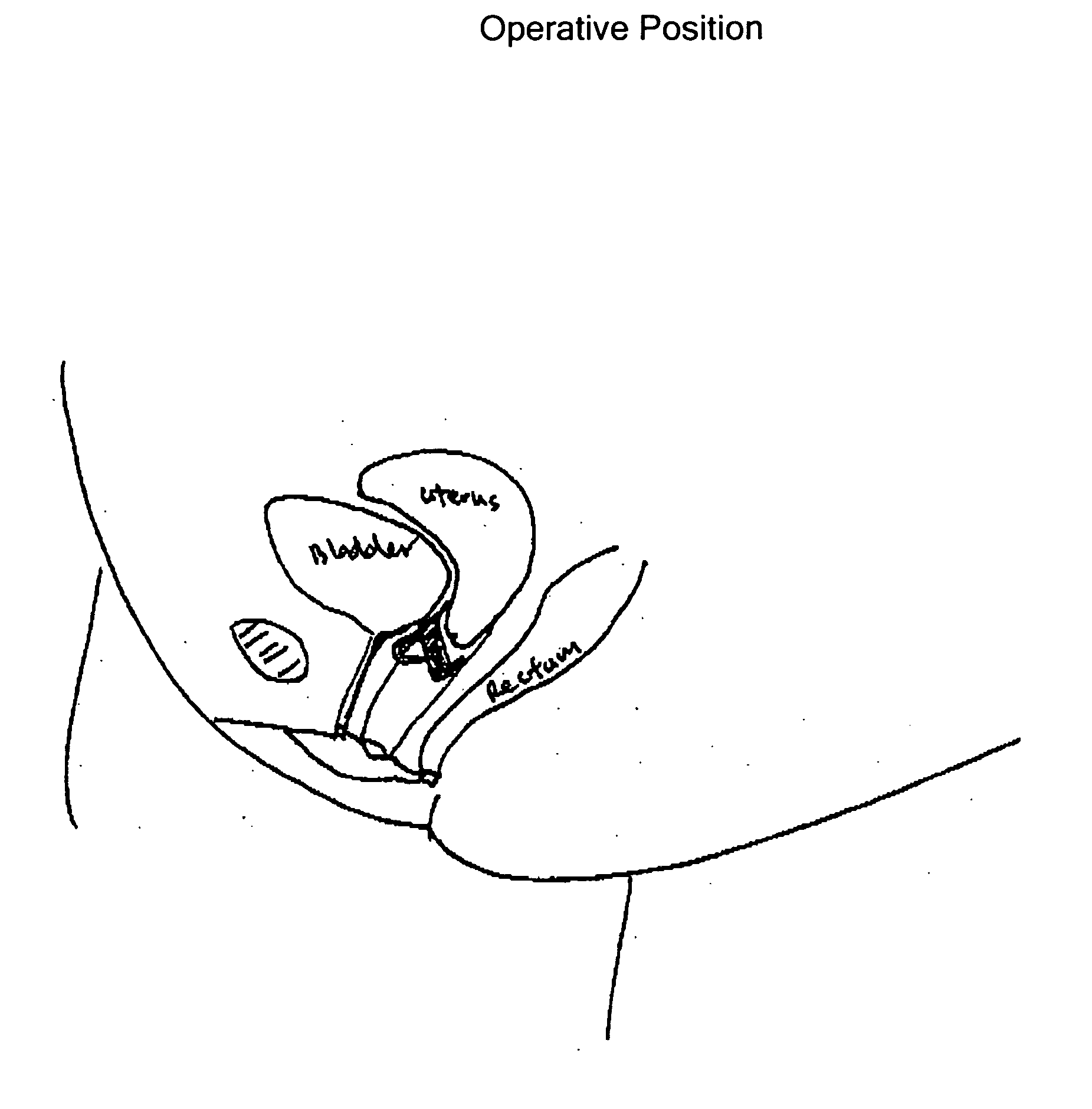 Device for anatomical support and uses thereof