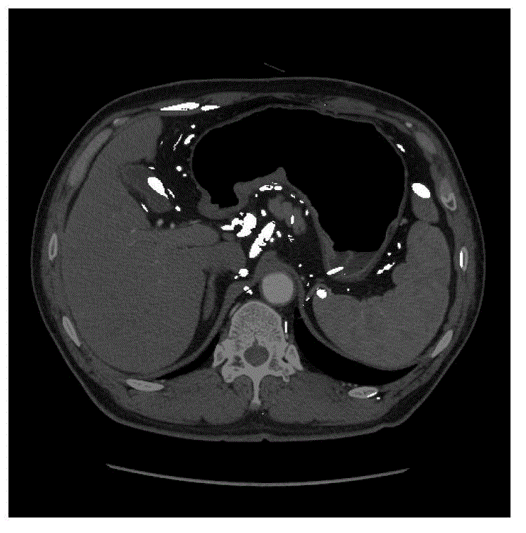 Lymph gland detection system and method based on stomach computed tomography (CT) image with shape fitting with oval