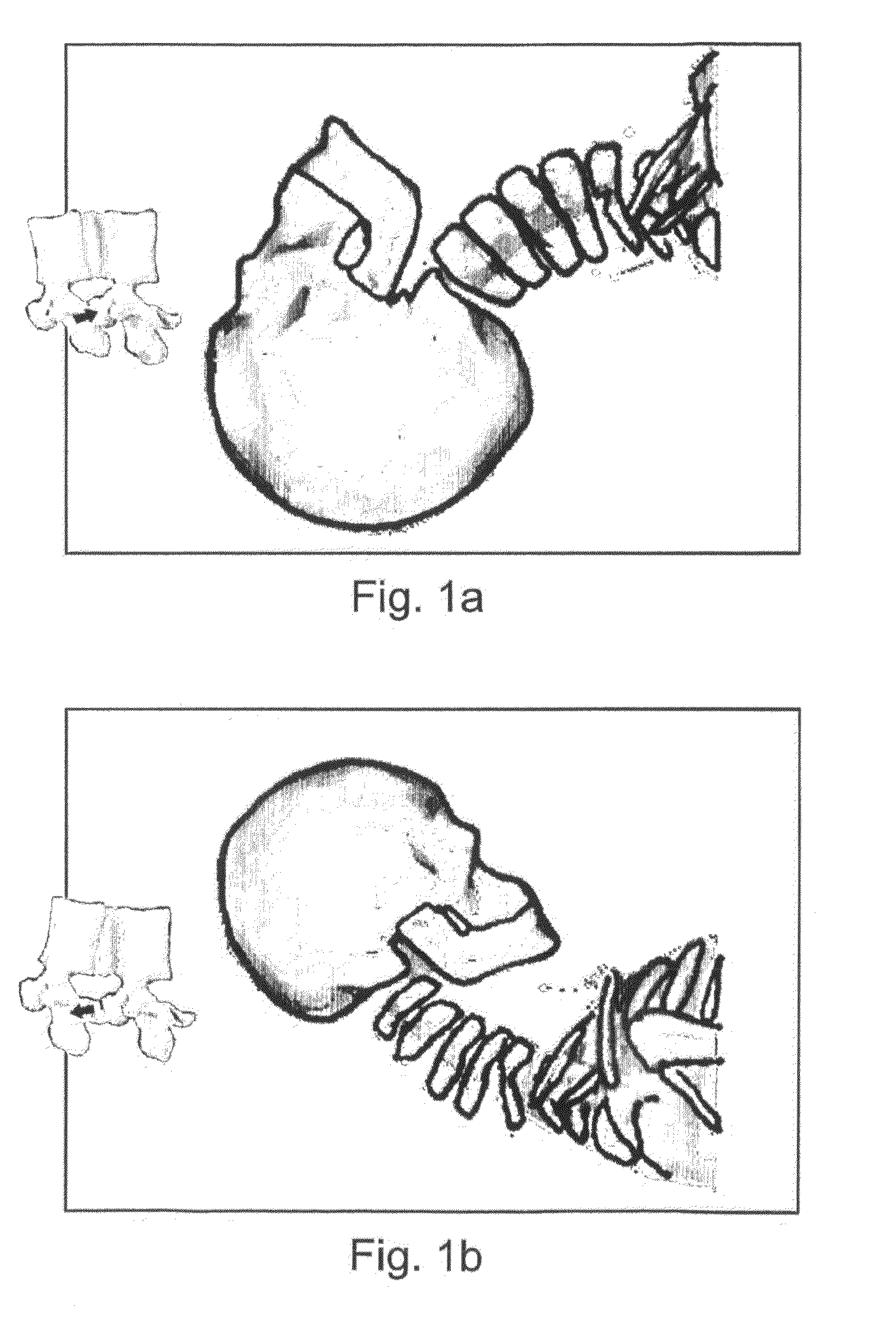 Device and Method for Treating Neck Tension or Neck Injury