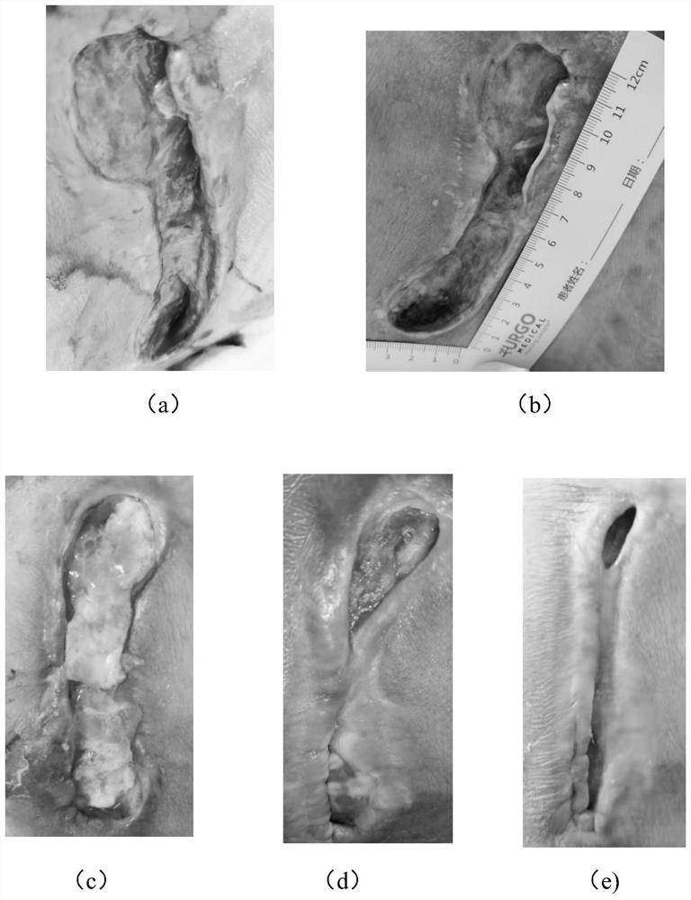 Biogel for treating refractory ulcer and preparation method thereof