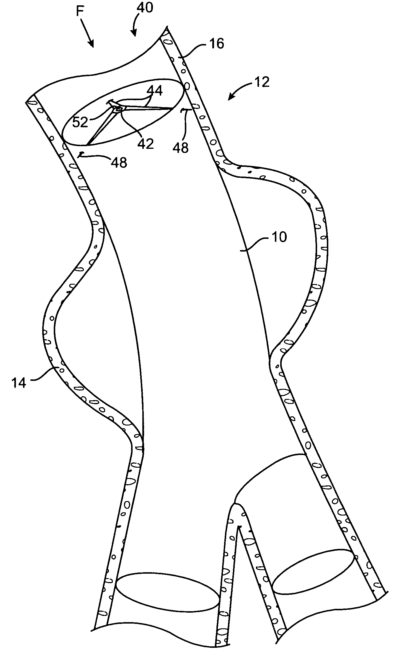 Intravascular securement device