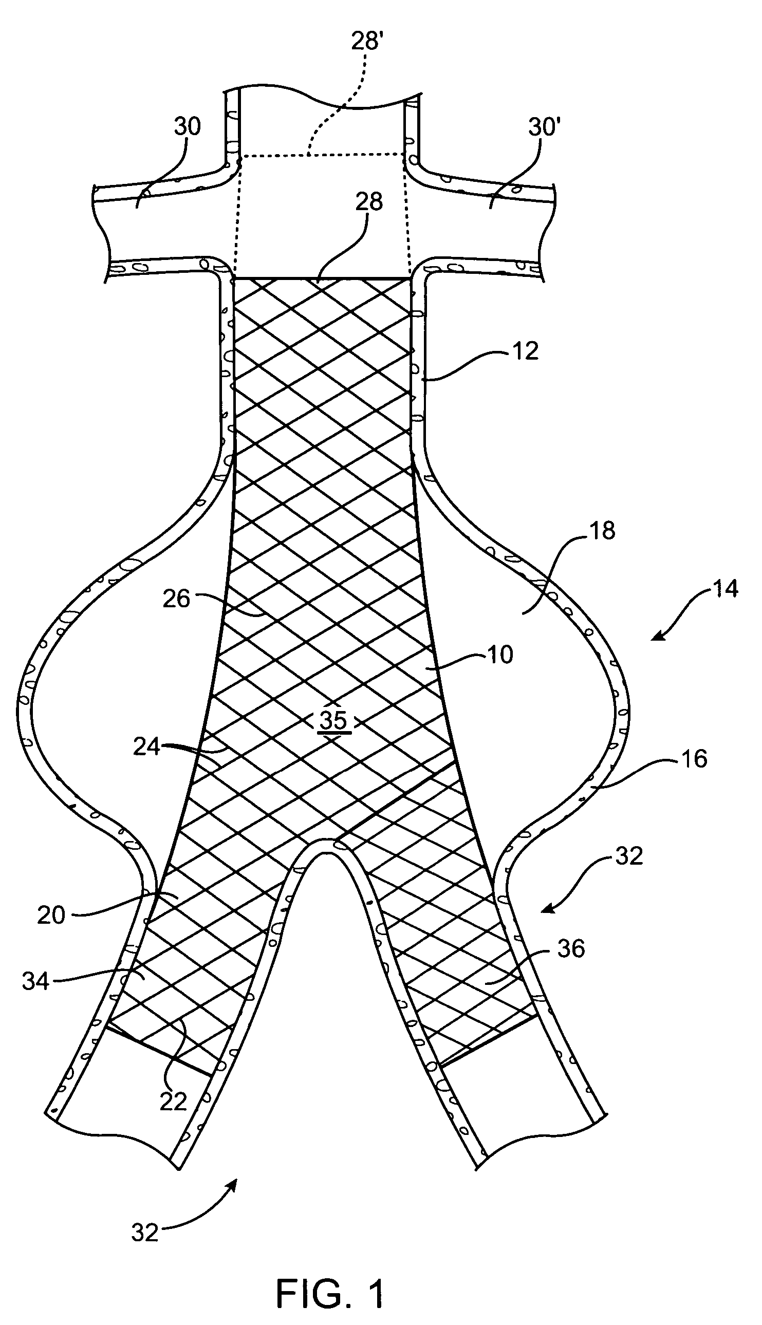 Intravascular securement device