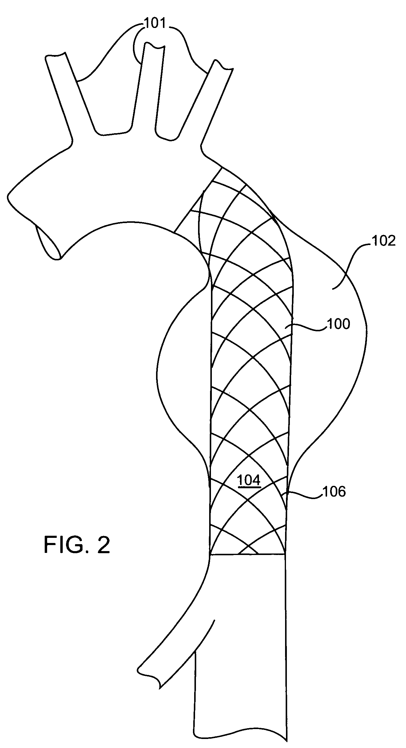 Intravascular securement device