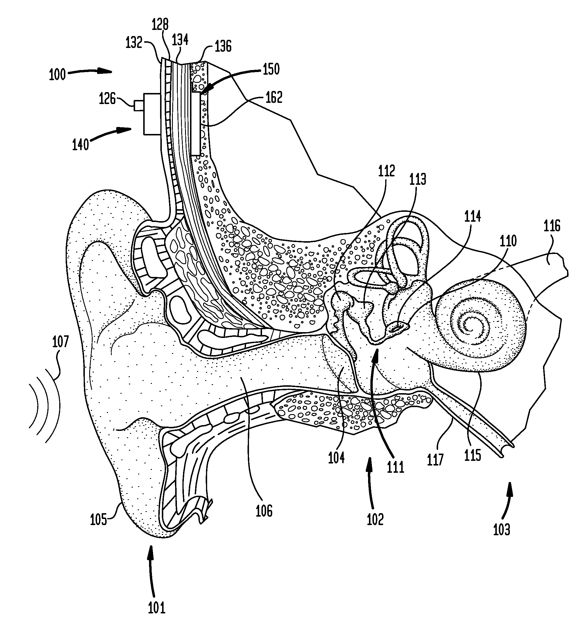 Implantable medical device