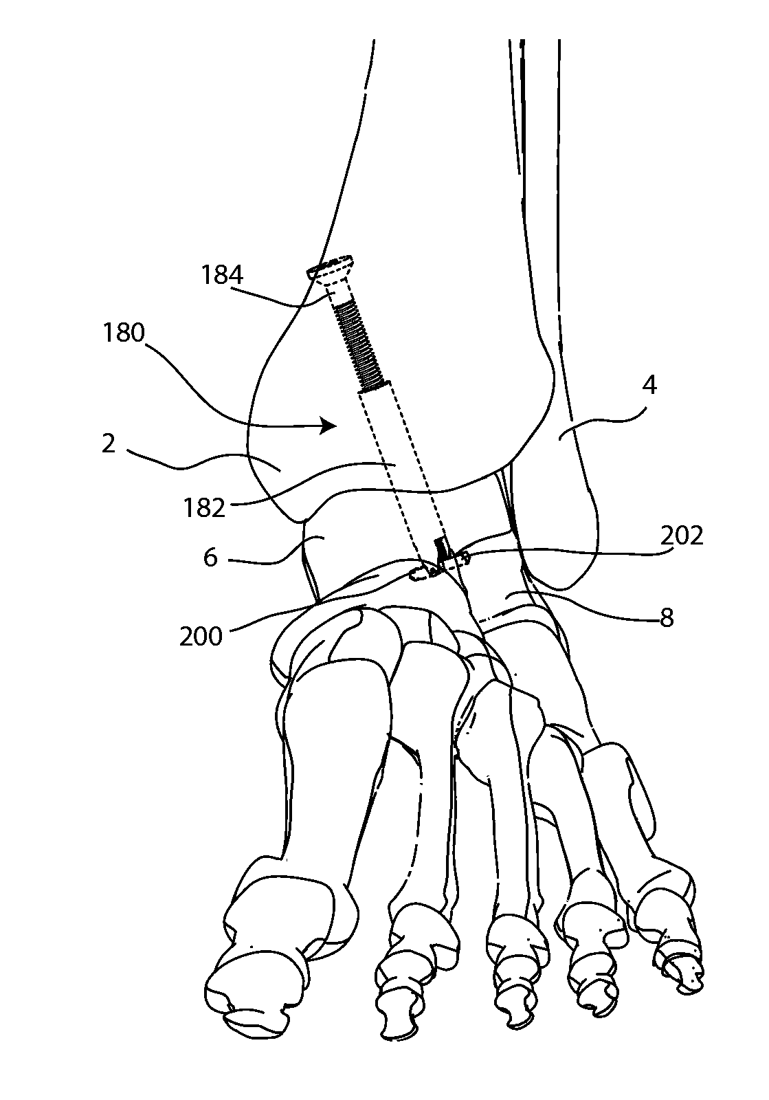 Joint Arthrodesis and Arthroplasty