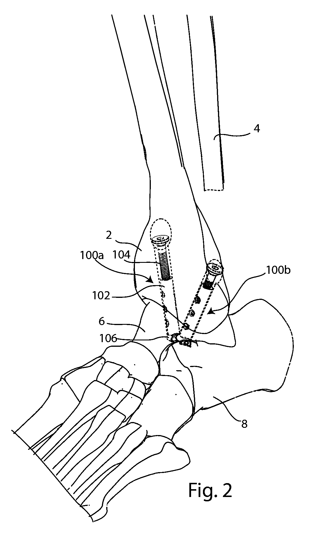 Joint Arthrodesis and Arthroplasty