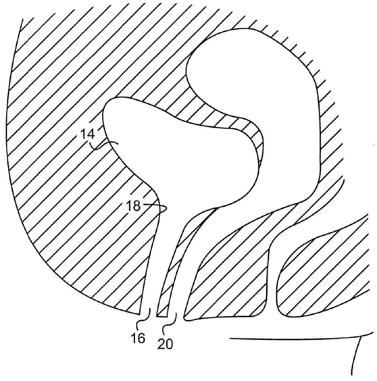 Method and articles for treatment of stress urinary incontinence