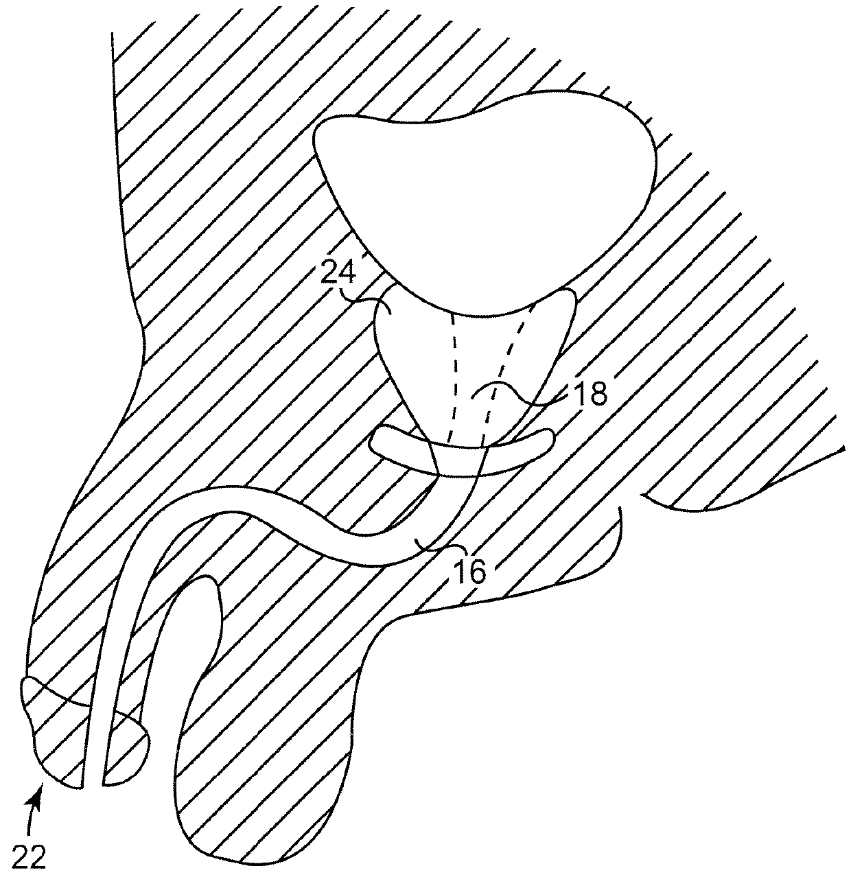 Method and articles for treatment of stress urinary incontinence