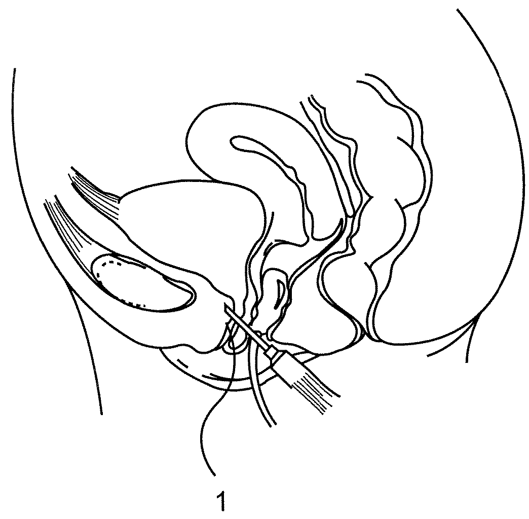 Method and articles for treatment of stress urinary incontinence