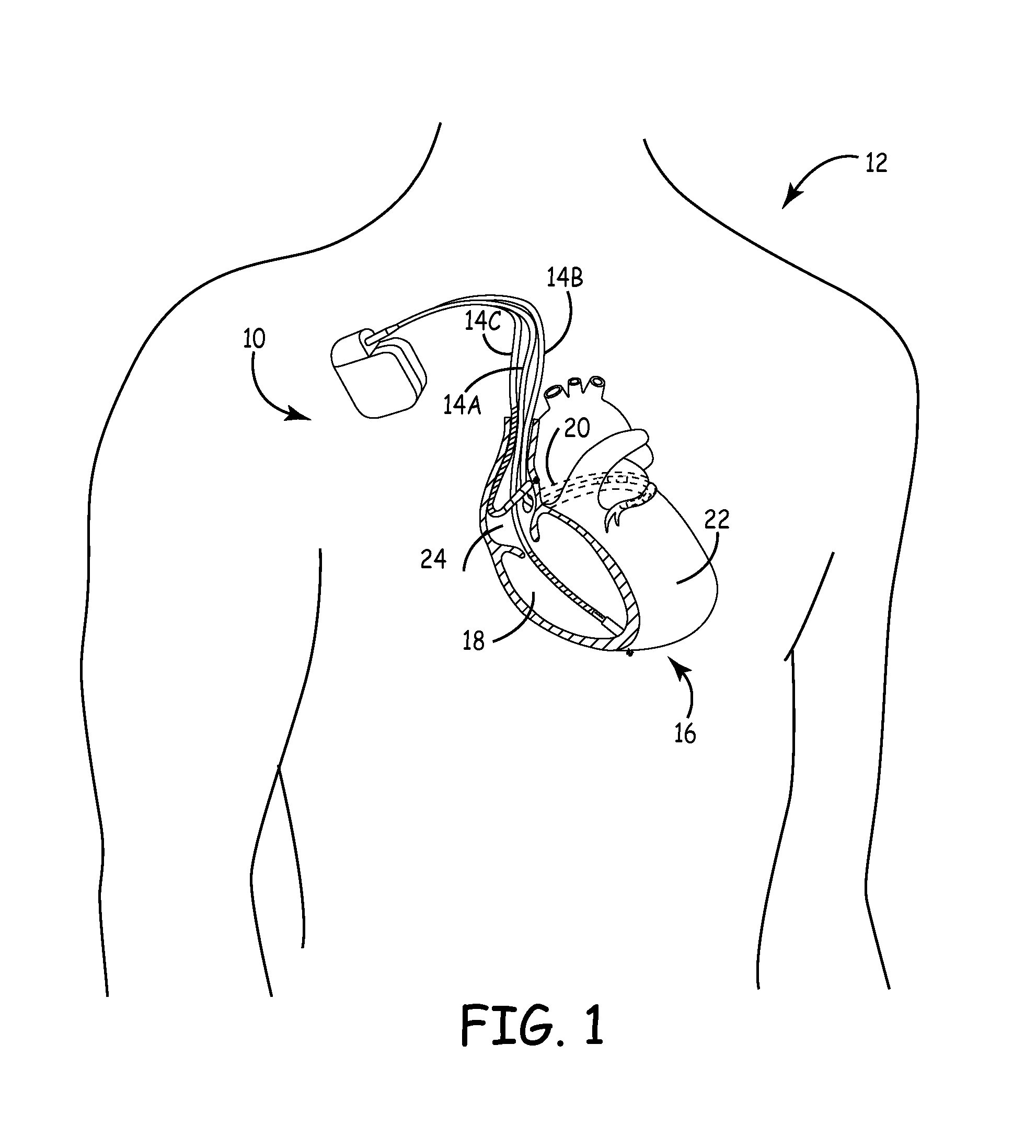 Delivery of CRT therapy during AT/AF termination