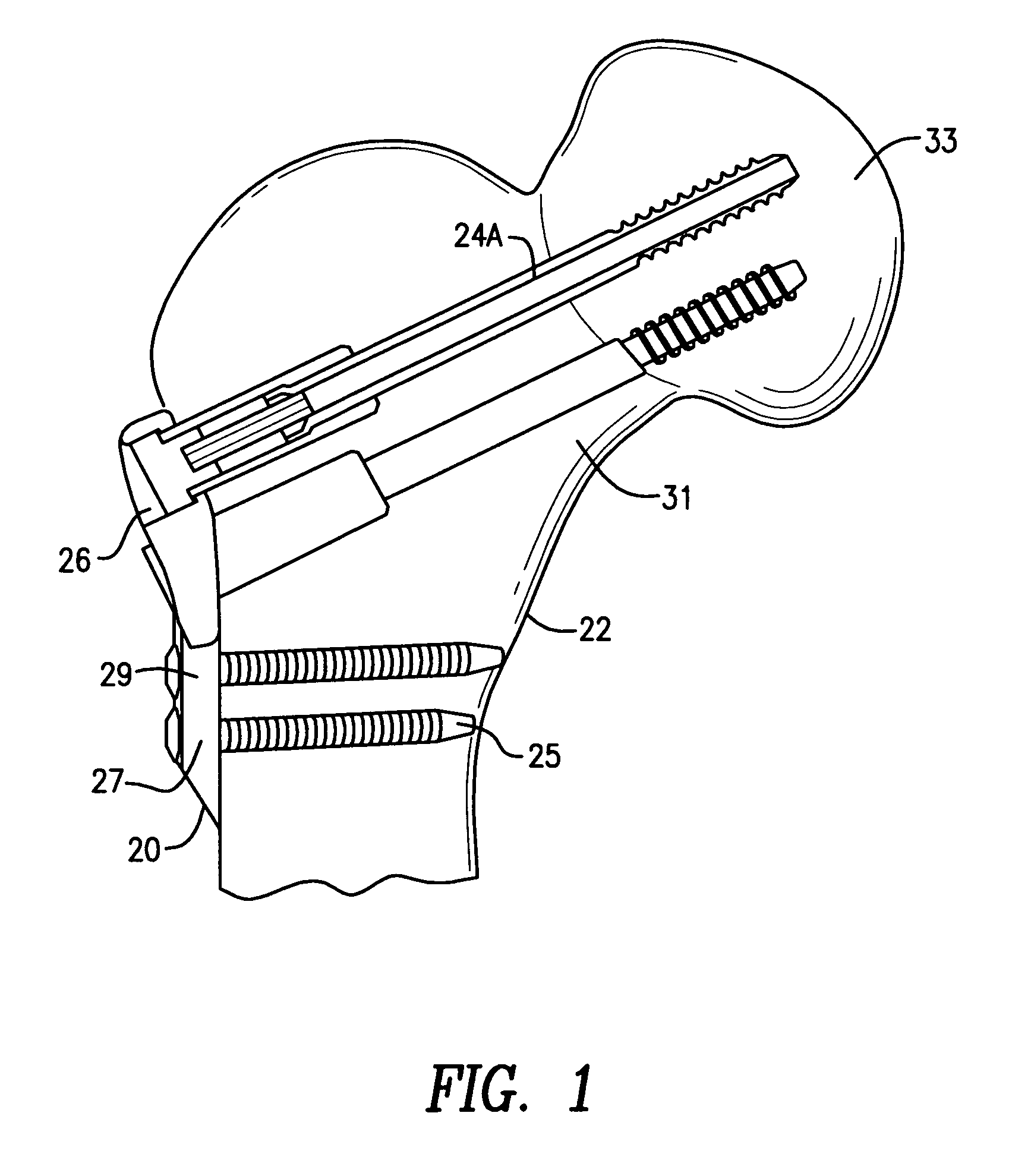 Hip fracture device with static locking mechanism allowing compression