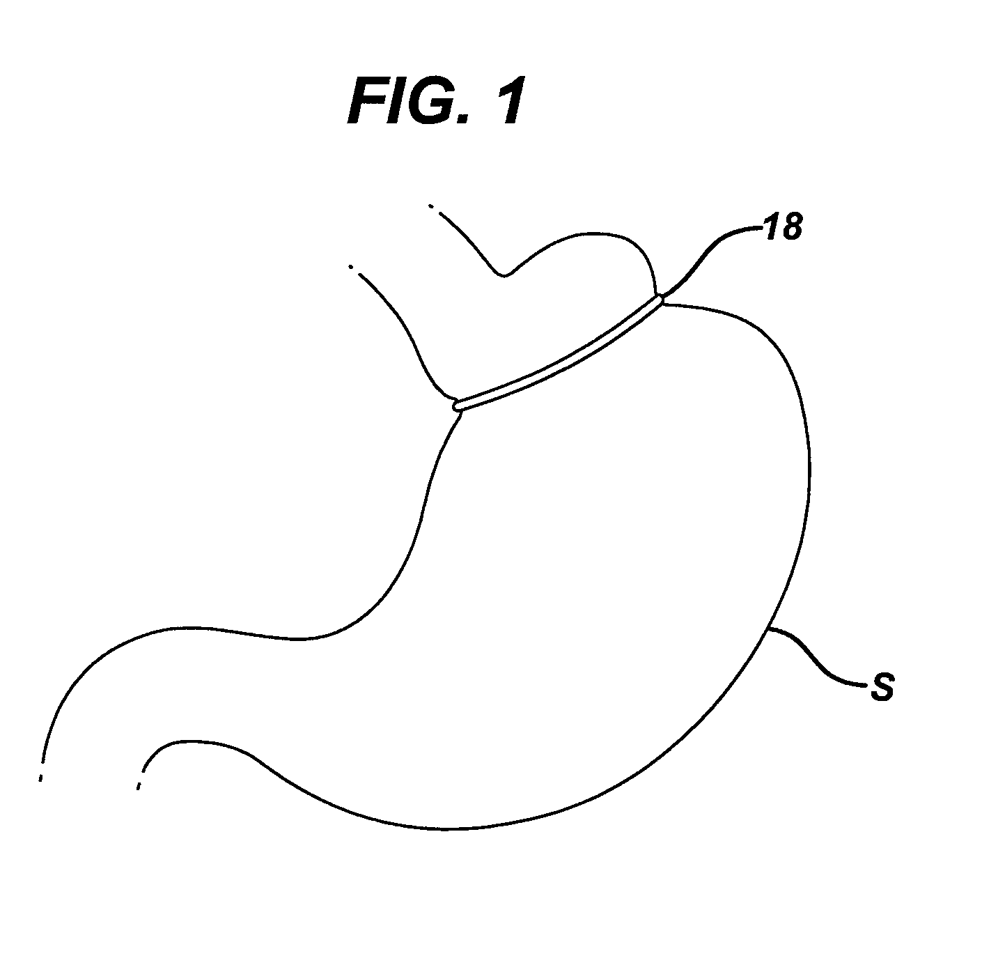 Methods and devices for placement of an intra-abdominal or intra-thoracic appliance through a natural body orifice