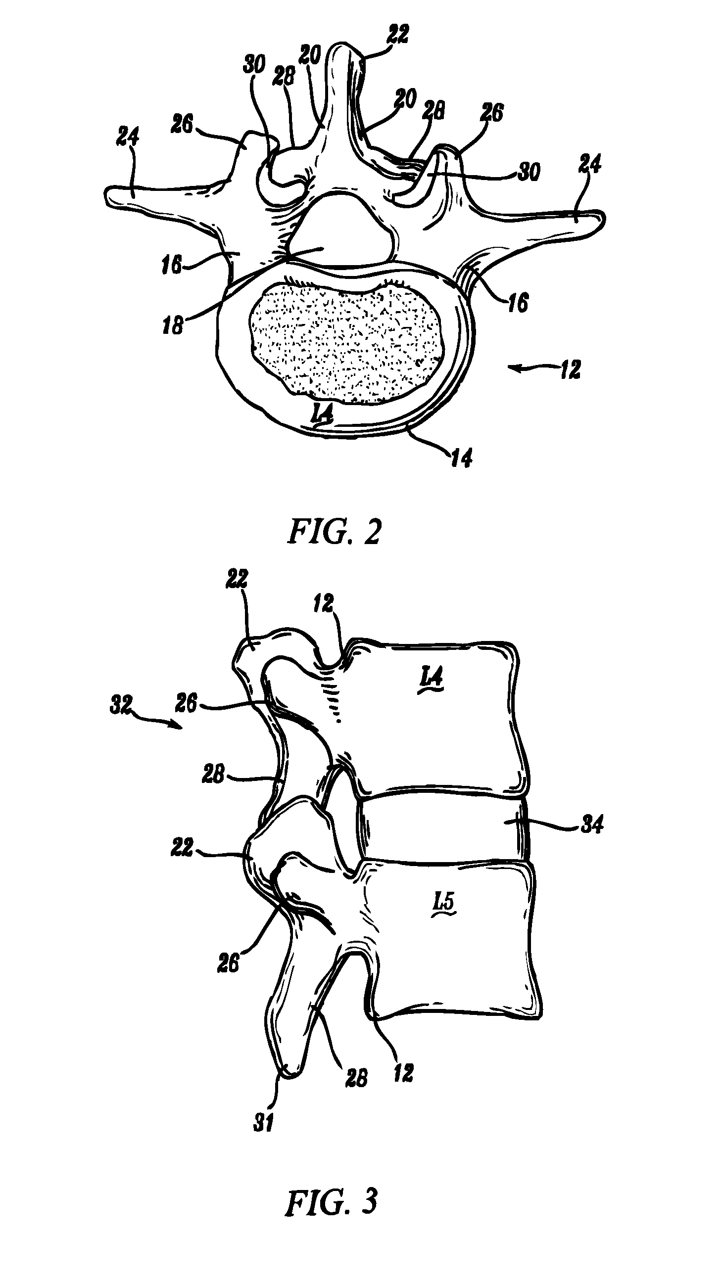 Anti-rotation fixation element for spinal prostheses